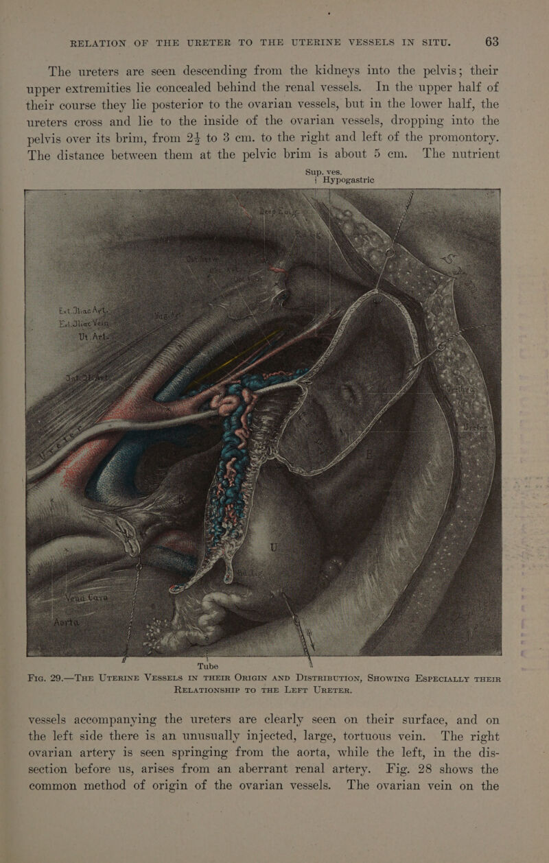 The ureters are seen descending from the kidneys into the pelvis; their upper extremities lie concealed behind the renal vessels. In the upper half of their course they lie posterior to the ovarian vessels, but in the lower half, the ureters cross and lie to the inside of the ovarian vessels, dropping into the pelvis over its brim, from 23 to 3 cm. to the right and left of the promontory. The distance between them at the pelvic brim is about 5 cm. The nutrient Sup. ves. 1 { Hypogastric Tube Fic. 29.—THE UTERINE VESSELS IN THEIR ORIGIN AND DISTRIBUTION, SHOWING ESPECIALLY THEIR RELATIONSHIP TO THE LEFT URETER. vessels accompanying the ureters are clearly seen on their surface, and on the left side there is an unusually injected, large, tortuous vein. The right ovarian artery is seen springing from the aorta, while the left, in the dis- section before us, arises from an aberrant renal artery. Fig. 28 shows the common method of origin of the ovarian vessels. The ovarian vein on the