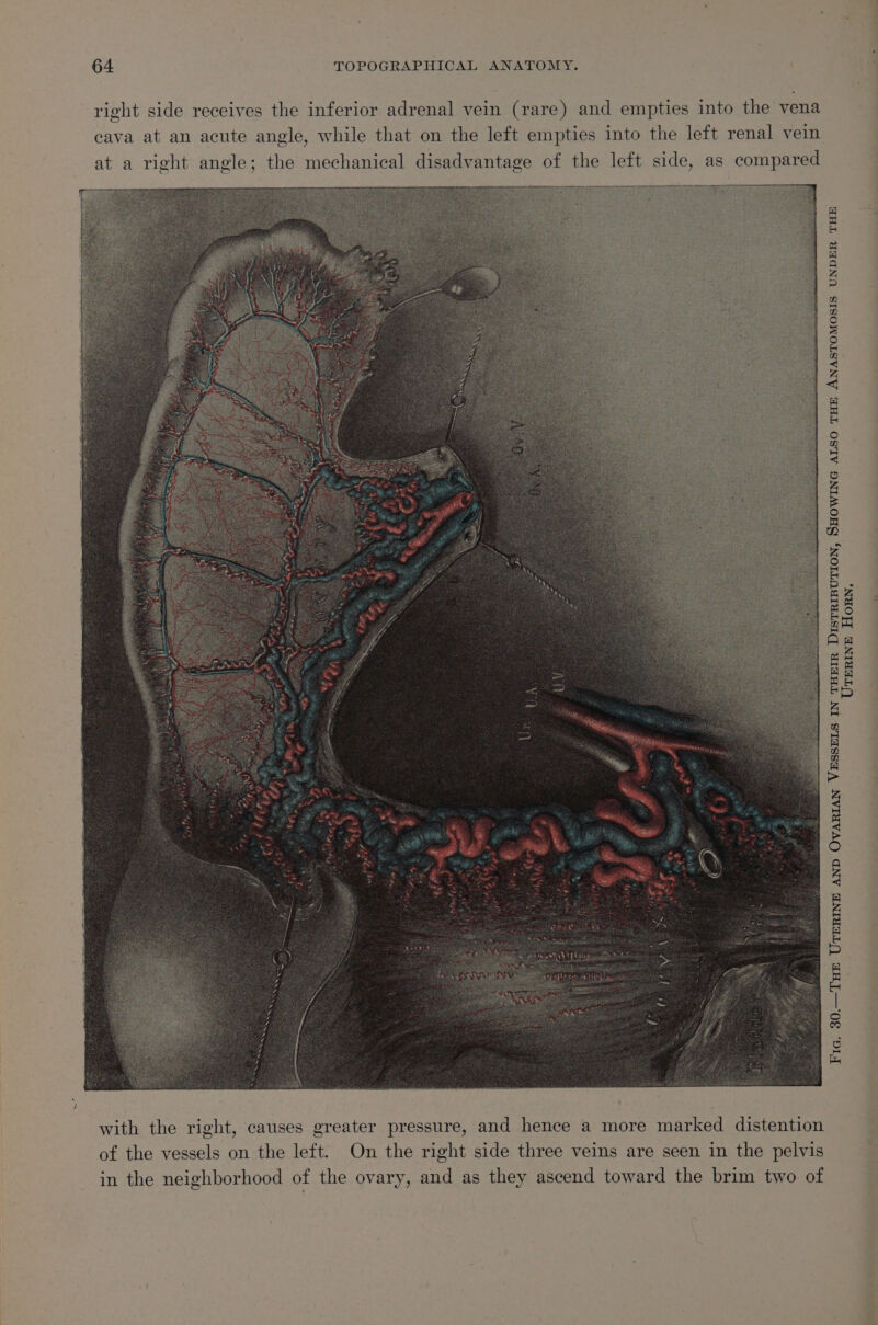 right side receives the inferior adrenal vein (rare) and empties into the vena cava at an acute angle, while that on the left empties into the left renal vein with the right, causes greater pressure, and hence a more marked distention of the vessels on the left. On the right side three veins are seen in the pelvis in the neighborhood of the ovary, and as they ascend toward the brim two of Fic. 30.—THE UTERINE AND OVARIAN VESSELS IN qo DISTRIBUTION, SHOWING ALSO THE ANASTOMOSIS UNDER THE TERINE Horn,