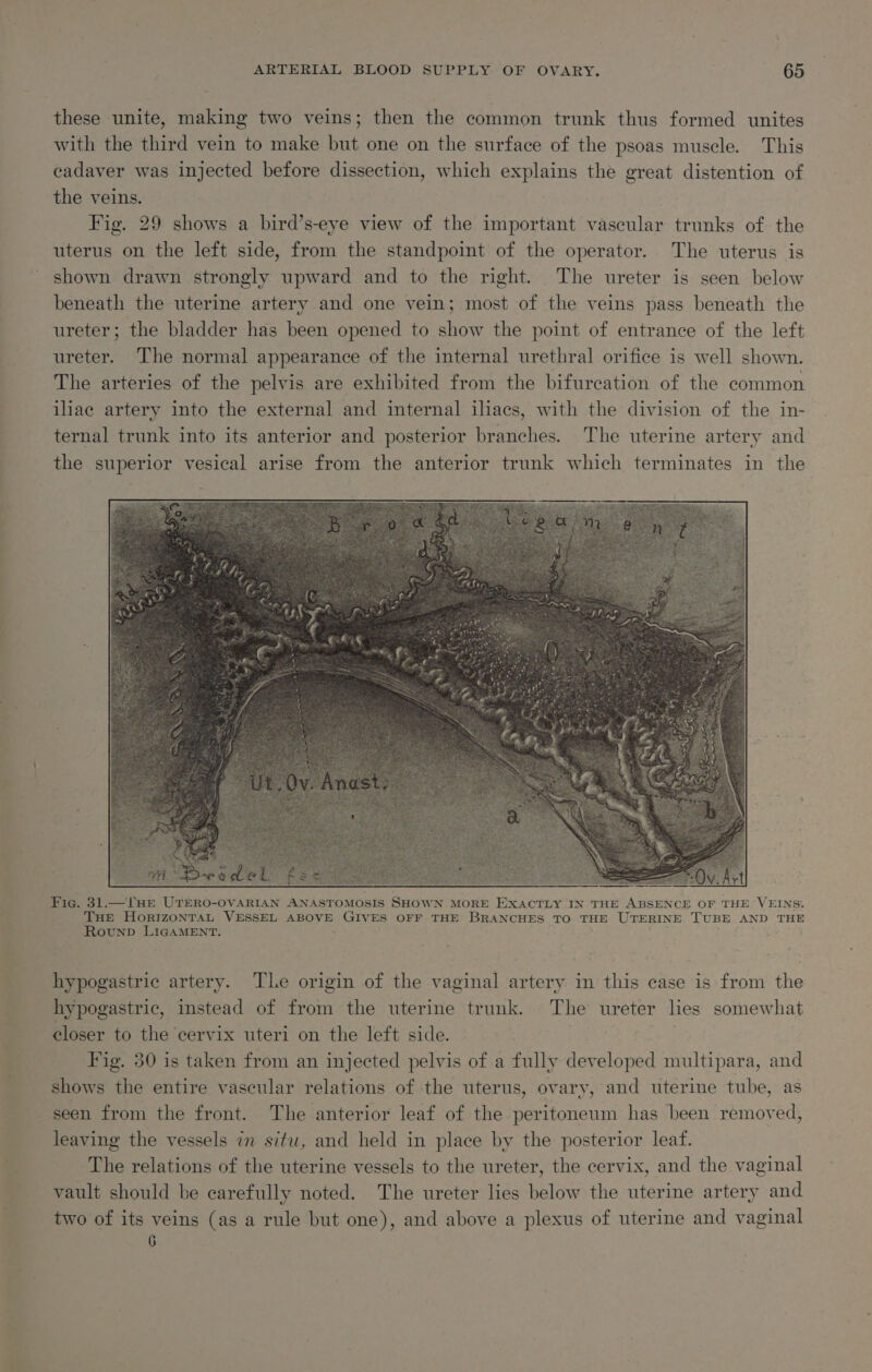 ARTERIAL BLOOD SUPPLY OF OVARY. — ©65 these unite, making two veins; then the common trunk thus formed unites with the third vein to make but one on the surface of the psoas muscle. This cadaver was injected before dissection, which explains the great distention of the veins. Fig. 29 shows a bird’s-eye view of the important vascular trunks of the uterus on the left side, from the standpoint of the operator. The uterus is shown drawn strongly upward and to the right. The ureter is seen below beneath the uterine artery and one vein; most of the veins pass beneath the ureter; the bladder has been opened to show the point of entrance of the left ureter. The normal appearance of the internal urethral orifice is well shown. The arteries of the pelvis are exhibited from the bifurcation of the common iliac artery into the external and internal iliacs, with the division of the in- ternal trunk into its anterior and posterior branches. The uterine artery and the superior vesical arise from the anterior trunk which terminates in the Fig. 31.—lHE UTERO-OVARIAN ANASTOMOSIS SHOWN MORE EXACTLY IN THE ABSENCE OF THE VEINS: Tue HortzonTaL VESSEL ABOVE GIVES OFF THE BRANCHES TO THE UTERINE TUBE AND THE Rounp LIGAMENT. hypogastric artery. Tle origin of the vaginal artery in this case is from the hypogastric, instead of from the uterine trunk. The ureter lies somewhat closer to the cervix uteri on the left side. Fig. 30 is taken from an injected pelvis of a fully ler cpee multipara, and shows the entire vascular relations of the uterus, ovary, and uterine tube, as _ seen from the front. The anterior leaf of the peritoneum has been removed, leaving the vessels in situ, and held in place by the posterior leaf. The relations of the uterine vessels to the ureter, the cervix, and the vaginal vault should be carefully noted. The ureter lies below the uterine artery and two of its veins (as a rule but one), and above a plexus of uterine and vaginal 6