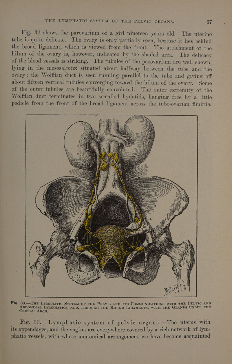Fig. 32 shows the parovarium of a girl nineteen years old. The uterine tube is quite delicate. The ovary is only partially seen, because it lies behind the broad ligament, which is viewed from the front. The attachment of the hilum of the ovary is, however, indicated by the shaded area. The delicacy of the blood vessels is striking. The tubules of the parovarium are well shown, lying in the mesosalpinx situated about halfway between the tube and the ovary; the Wolffian duct is seen running parallel to the tube and giving off about fifteen vertical tubules converging toward the hilum of the ovary. Some of the outer tubules are beautifully convoluted. The outer extremity of the Wolffian. duct terminates in two so-called hydatids, hanging free by a little pedicle from the front of the broad ligament across the tubo-ovarian fimbria. Ure \\ 7 7 SS SS SSS a = = XS Fic. 33.—Tue Lympnatic System of THE PELVIS AND ITS COMMUNICATIONS WITH THE PELVIC AND ABDOMINAL LYMPHATICS, AND, THROUGH THE RoUND LIGAMENTS, WITH THE GLANDS UNDER THE CRURAL ARCH. Fig. 33. Lymphatic system of pelvic organs.—The uterus with its appendages, and the vagina are everywhere covered by a rich network of lym- phatic vessels, with whose anatomical arrangement we have become acquainted