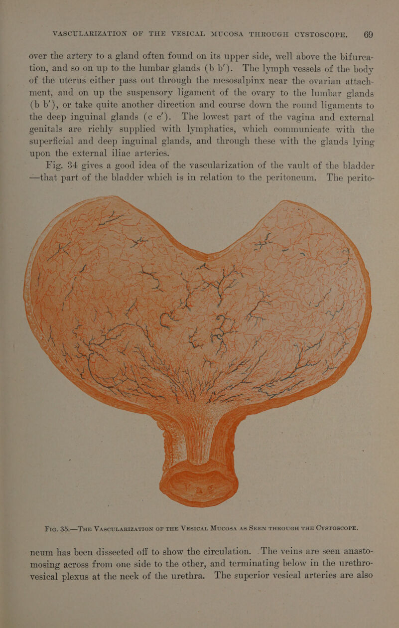 over the artery to a gland often found on its upper side, well above the bifurea- tion, and so on up to the lumbar glands (b b’). The lymph vessels of the body of the uterus either pass out through the mesosalpinx near the ovarian attach- ment, and on up the suspensory hgament of the ovary to the lumbar glands (b b’), or take quite another direction and course down the round ligaments to the deep inguinal glands (¢ c’). The lowest part of the vagina and external genitals are richly supplied with lymphatics, which communicate with the superficial and deep inguinal glands, and through these with the glands lying ‘upon the external iliac arteries. Fig. 34 gives a good idea of the vascularization of the vault of the bladder —that part of the bladder which is in relation to the peritoneum. The perito- -neum has been dissected off to show the circulation. .The veins are seen anasto- mosing across from one side to the other, and terminating below in the urethro- vesical plexus at the neck of the urethra. The superior vesical arteries are also