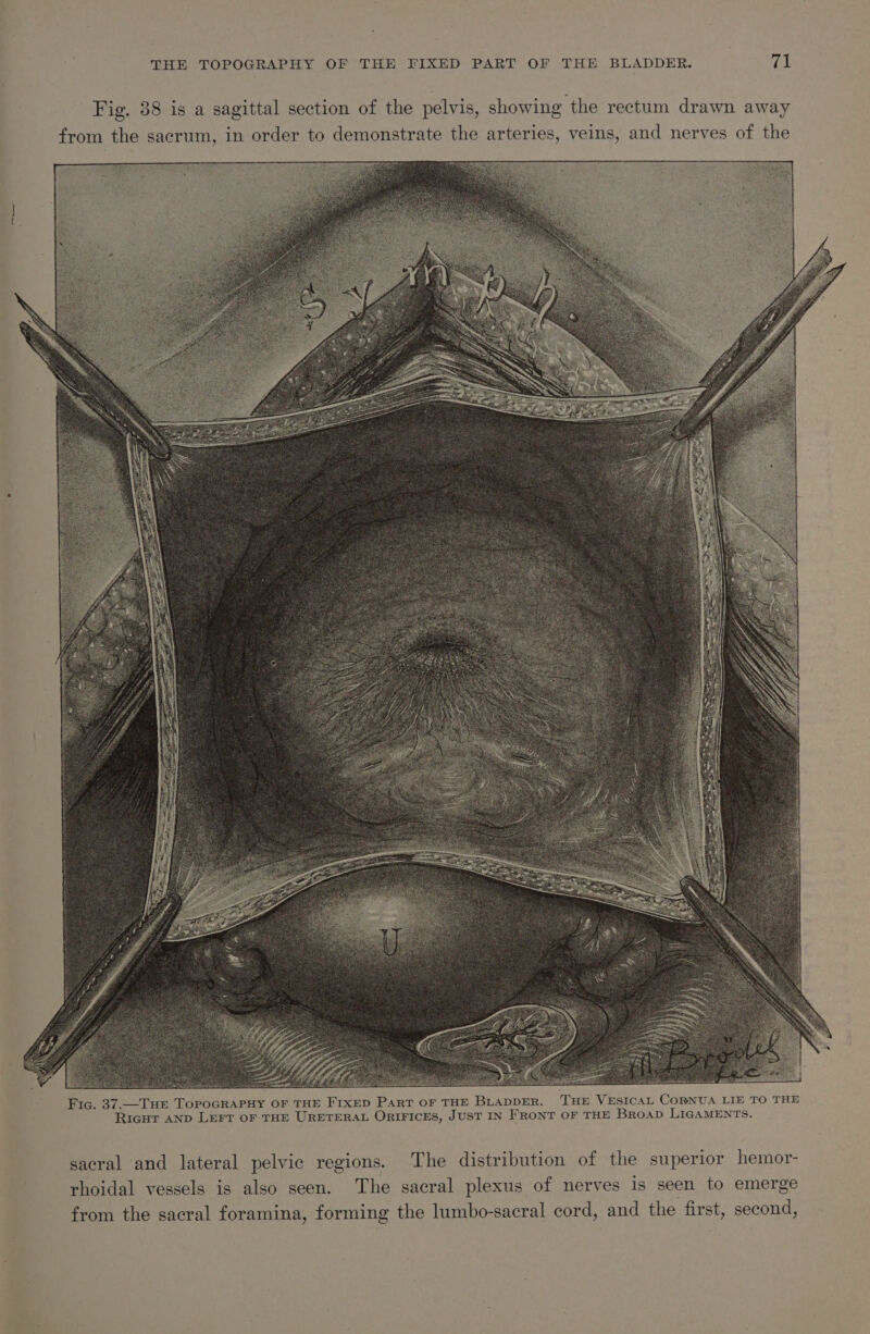 THE TOPOGRAPHY OF THE FIXED PART OF THE BLADDER. fa! Fic. 37.—THE TorpoGRAPHY OF THE FIXED Part oF THE BLADDER. THE VESICAL CORNUA LIE TO THE RiagHT AND LEFT OF THE URETERAL ORIFICES, JUST IN FRONT OF THE Broap LIGAMENTS. sacral and lateral pelvic regions. The distribution of the superior hemor- rhoidal vessels is also seen. The sacral plexus of nerves is seen to emerge from the sacral foramina, forming the lumbo-sacral cord, and the first, second,