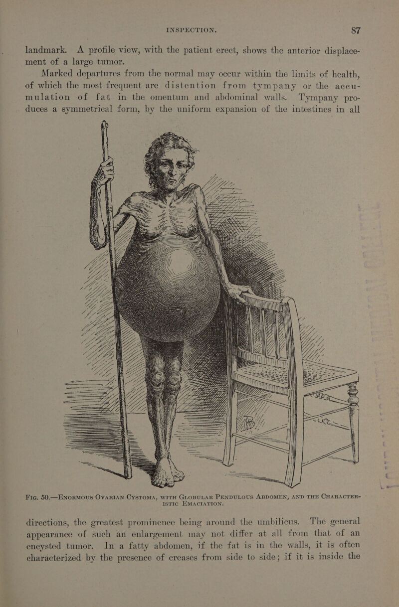 landmark. A profile view, with the patient erect, shows the anterior displace- ment of a large tumor. Marked departures from the normal may occur within the limits of health, of which the most frequent are distention from tympany or the accu- mulation of fat in the omentum and abdominal walls. Tympany pro- duces a symmetrical form, by the uniform expansion of the intestines in all ey SSS Ss —S Life ATLL STL LL tye NZ in Ley DD Y | YY y, Fia. 50.—ENoRMOUS OVARIAN CysTOMA, WITH GLOBULAR PENDULOUS ABDOMEN, AND THE CHARACTER- - ISTIC HMACIATION. directions, the greatest prominence being around the umbilicus. The general appearance of such an enlargement may not differ at all from that of an encysted tumor. In a fatty abdomen, if the fat is in the walls, it is often characterized by the presence of creases from side to side; if it is imside the