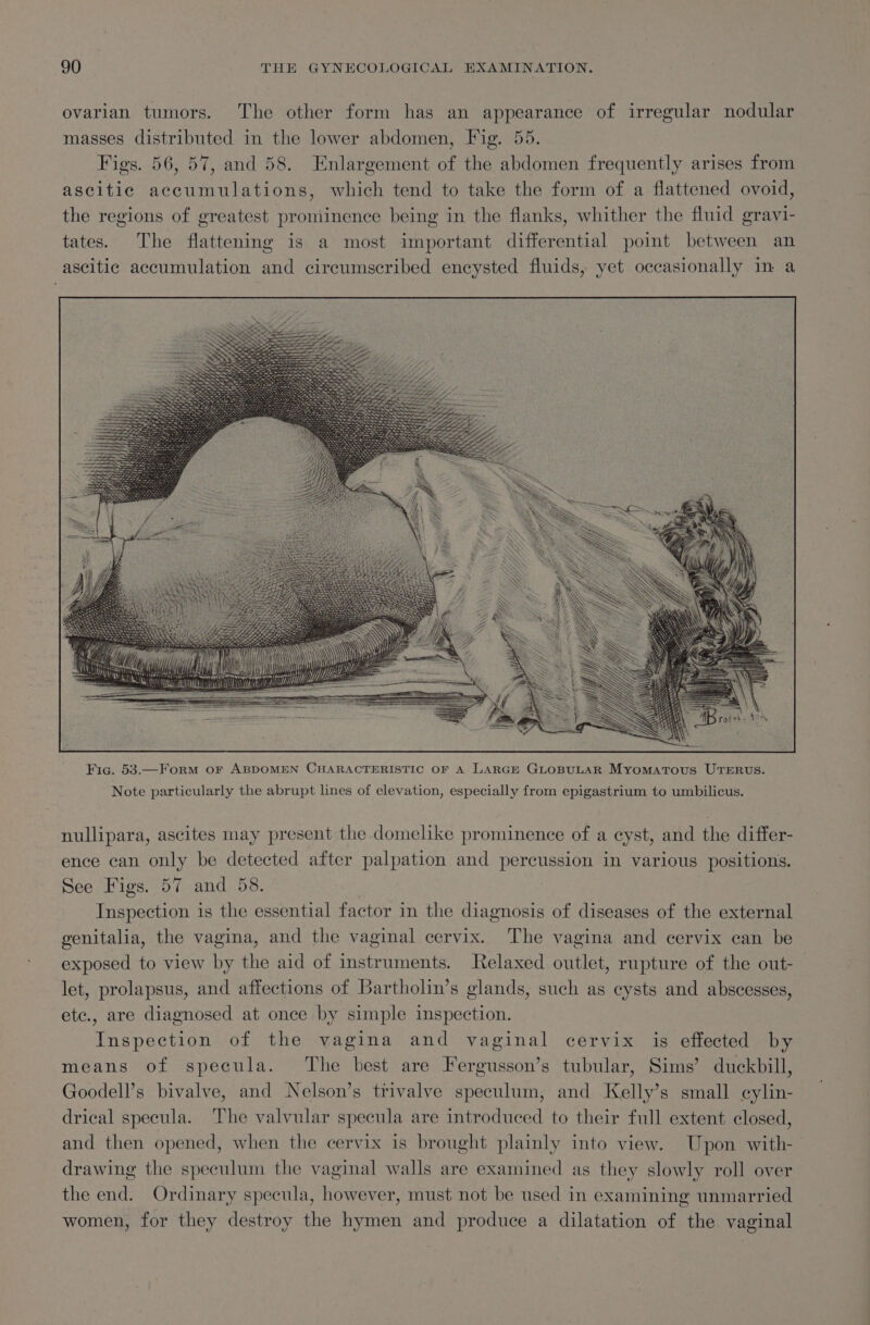 ovarian tumors. The other form has an appearance of irregular nodular masses distributed in the lower abdomen, Fig. 55. Figs. 56, 57, and 58. Enlargement of the abdomen frequently arises from ascitic accumulations, which tend to take the form of a flattened ovoid, the regions of greatest proniinence being in the flanks, whither the fluid gravi- tates. The flattening is a most important differential point between an ascitic accumulation and circumscribed encysted fluids, yet occasionally in a Fic. 53.—Form or ABDOMEN CHARACTERISTIC OF A LARGE GLOBULAR Myomatous UTERUS. Note particularly the abrupt lines of elevation, especially from epigastrium to umbilicus. nullipara, ascites may present the domelike prominence of a eyst, and the differ- ence can only be detected after palpation and percussion in various positions. See Figs. 57 and 58. ; Inspection is the essential factor in the diagnosis of diseases of the external genitalia, the vagina, and the vaginal cervix. The vagina and cervix can be exposed to view by the aid of instruments. Relaxed outlet, rupture of the out- let, prolapsus, and affections of Bartholin’s glands, such as cysts and abscesses, etc., are diagnosed at once by simple inspection. Inspection of the vagina and vaginal cervix is effected by means of specula. The best are Fergusson’s tubular, Sims’ duckbill, Goodell’s bivalve, and Nelson’s trivalve speculum, and Kelly’s small cylin- drical specula. The valvular specula are introduced to their full extent closed, and then opened, when the cervix is brought plainly into view. Upon with- drawing the speculum the vaginal walls are examined as they slowly roll over the end. Ordinary specula, however, must not be used in examining unmarried women, for they destroy the hymen and produce a dilatation of the. vaginal