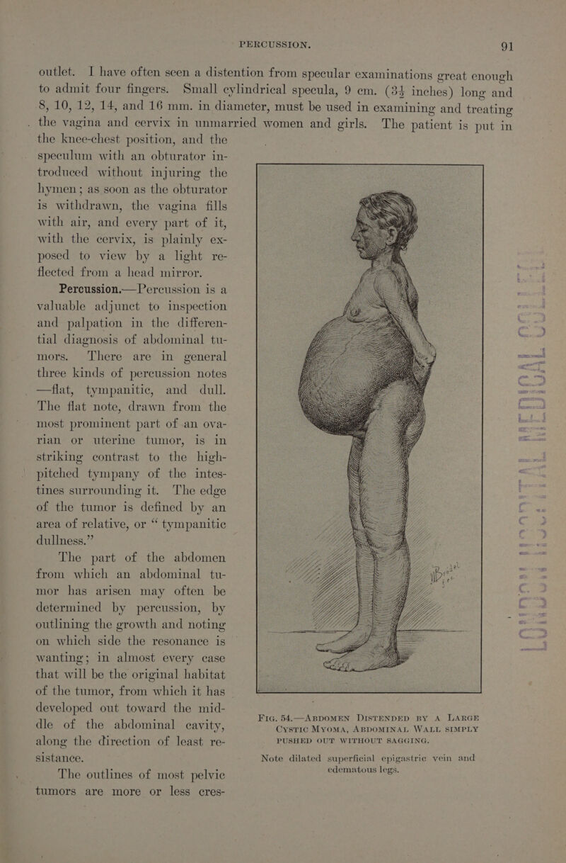PERCUSSION. QO] outlet. I have often seen a distention from specular examinations great enough to admit four fingers. Small cylindrical specula, 9 em. (34 inches ) long and 8, 10, 12, 14, and 16 mm. in diameter, must be used in examining and treating this vagina and cervix in unmarried women and girls. The patient is put in the knee-chest position, and the speculum with an obturator in- troduced without injuring the hymen; as soon as the obturator is withdrawn, the vagina fills with air, and every part of it, with the cervix, is plainly ex- posed to view by a light re- flected from a head mirror. Percussion.—Percussion is a valuable adjunct to inspection and palpation in the differen- tial diagnosis of abdominal tu- mors. There. are in general three kinds of percussion notes —flat, tympanitic, and dull. The flat note, drawn from the most prominent part of .an ova- rian or uterine tumor, is in striking contrast to the high- pitched tympany of the intes- tines surrounding it. The edge of the tumor is defined by an area of relative, or “ tympanitic dullness.” The part of the abdomen from which an abdominal tu- mor has arisen may often be determined by percussion, by outlining the growth and noting on which side the resonance is wanting; in almost every case that will be the original habitat of the tumor, from which it has developed out toward the mid- dle of the abdominal cavity, Cystic Myoma, ABDOMINAL WALL SIMPLY along the direction of least re- PUSHED OUT WITHOUT SAGGING. sistance. Note dilated superficial epigastric vein and i d at legs. The outlines of most pelvic edematous legs tumors are more or less cres-