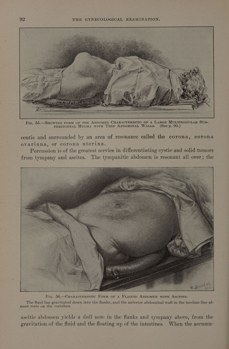 Fig, 55.—SHOWING FORM OF THE ABDOMEN CHARACTERISTIC OF A LARGE MULTINODULAR SUB- PERITONEAL MyoMaA WITH THIN ABDOMINAL WALLS. (See p. 90.) centic and surrounded by an area of resonance called the corona, corona: ovariana, or corona uterina. : Percussion is of the greatest service in differentiating cystic and solid tumors from tympany and ascites. The tympanitic abdomen is resonant all over; the lig. 56.—CHARACTERISTIC ForM or A FnLAccIp ABDOMEN wiITH ASCITES. The fluid has gravitated down into the flanks, and the anterior abdominal wall in the median line al- most rests on the vertebrie ascitic abdomen yields a dull note in the flanks and tympany above, from the gravitation of the fluid and the floating up of the intestines. When the accumu-