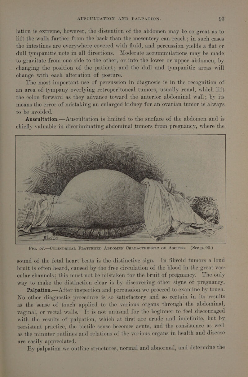 lation is extreme, however, the distention of the abdomen may be so great as to lift the walls farther from the back than the mesentery can reach; in such cases the intestines are everywhere covered with fluid, and percussion yields a flat or dull tympanitic note in all directions. Moderate accummulations may be made to gravitate from one side to the other, or into the lower or upper abdomen, by changing the position of the patient; and the dull and tympanitic areas will change with each alteration of posture. , The most important use of percussion in diagnosis is in the recognition of an area of tympany overlying retroperitoneal tumors, usually renal, which lift the colon forward as they advance toward the anterior abdominal wall; by its means the error of mistaking an enlarged kidney for an ovarian tumor is always to be avoided. Auscultation.— Auscultation is limited to the surface of the abdomen and is chiefly valuable in discriminating abdominal tumors from pregnancy, where the sound of the fetal heart beats is the distinctive sign. In fibroid tumors a loud bruit is often heard, caused by the free circulation of the blood in the great vas- cular channels; this must not be mistaken for the bruit of pregnancy. The only way to make the distinction clear is by discovering other signs of pregnancy. Palpation.—After inspection and percussion we proceed to examine by touch. No other diagnostic procedure is so satisfactory and so certain in its results as the sense of touch applied to the various organs through the abdominal, vaginal, or rectal walls. It is not unusual for the beginner to feel discouraged with the results of palpation, which at first are crude and indefinite, but by persistent practice, the tactile sense becomes acute, and the consistence as well as the minuter outlines and relations of the various organs in health and disease are easily appreciated. By palpation we outline structures, normal and abnormal, and determine the