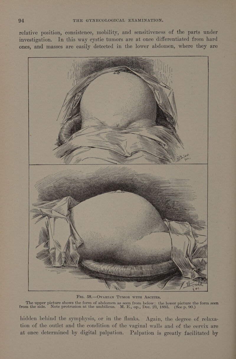 relative position, consistence, mobility, and sensitiveness of the parts under investigation. In this way cystic tumors are at once differentiated from hard ones, and masses are easily detected in the lower abdomen, where they are The upper picture shows the form of abdomen as seen from below; the lower picture the form seen ° from the side. Note protrusion at the umbilicus. M. E., op., Dec. 23, 1895. (See p. 90.) hidden behind the symphysis, or in the flanks. Again, the degree of relaxa- tion of the outlet and the condition of the vaginal walls and of the cervix are at once determined by digital palpation. Palpation is greatly facilitated by