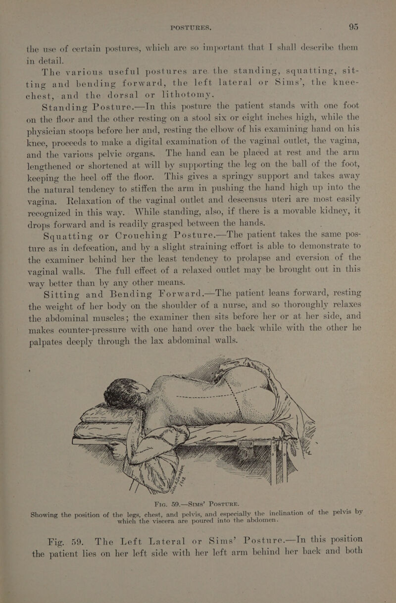 the use of certain postures, which are so important that IT shal! describe them in detail. | } The varicus useful postures are the standing, squatting, sit- ting and bending forward, the left lateral or Sims’, the knee- chest, and the dorsal or lithotomy. Standing Posture.—In this posture the patient stands with one foot on the floor and the other resting on a stool six or eight inches high, while the physician stoops before her and, resting the elbow of his examining hand on his knee, proceeds to make a digital examination of the vaginai outlet, the vagina, and the various pelvic organs. The hand can be placed at rest and the arm lengthened or shortened at will by supporting the leg on the ball of the foot, keeping the heel off the floor. This gives a springy support and takes away the natural tendency to stiffen the arm in pushing the hand high up into the vagina. Relaxation of the vaginal outlet and descensus uteri are most easily recognized in this way. While standing, also, if there is a movable kidney, it drops forward and is readily grasped between the hands. Squatting or Crouching Posture.—The patient takes the same pos- ture as in defecation, and bya slight straining effort is able to demonstrate to the examiner behind her the least tendency to prolapse and eversion of the vaginal walls. The full effect of a relaxed outlet may be brought out in this way better than by any other means. Sitting and Bending Forward.—The patient leans forward, resting the weight of her body on the shoulder of a nurse, and so thoroughly relaxes the abdominal muscles; the examiner then sits before her or at her side, and makes counter-pressure with one hand over the back while with the other he palpates deeply through the lax abdominal walls. Showing the position of the legs, chest, and pelvis, and especially the inclination of the pelvis by which the viscera are poured into the abdomen. Fig. 59. The Left Lateral or Sims’ Posture.—In this position the patient lies on her left side with her left arm behind her back and both