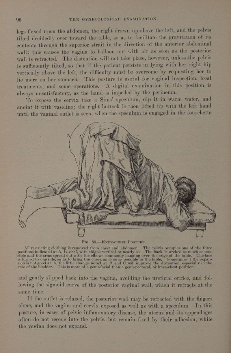 legs flexed upon the abdomen, the right drawn up above the left, and the pelvis tilted decidedly over toward the table, so as to facilitate the gravitation of its contents through the superior strait in the direction of the anterior abdominal wall; this causes the vagina to balloon out with air as soon as the posterior wall is retracted. The distention will not take place, however, unless the pelvis is sufficiently tilted, so that if the patient persists in lying with her right hip vertically above the left, the difficulty must be overcome by requesting her to lie more on her stomach. This posture is useful for vaginal inspection, local treatments, and some operations. A digital examination in this position 1s always unsatisfactory, as the hand is impeded by the perineum. To expose the cervix take a Sims’ speculum, dip it in warm water, and anoint it with vaseline; the right buttock is then lifted up with the left hand until the vaginal outlet is seen, when the speculum is engaged in the fourchette &lt;7 ee a eae VLE SVR y es = \ 4 hh 14 aN ff: | yy Rah 7 | , i BCA NS i Ml tae es Fig. 60.—KNEE-CHEST POSTURE. All restricting clothing is removed from chest and abdomen. The pelvis occupies one of the three positions indicated at A, B, or C, with thighs vertical or nearly so. The back is arched as much as pos- sible and the arms spread out with the elbows commonly hanging over the edge of the table. The face is turned to one side, so as to bring the cheek as close as possible to the table. Sometimes if the expan- sion is not good at A, the little change noted at B and C will improve the distention, especially in the ease of the bladder. This is more of a genu-facial than a genu-pectoral, or knee-chest position. and gently slipped back into the vagina, avoiding the urethral orifice, and fol- lowing the sigmoid curve of the posterior vaginal wall, which it retracts at the same time. | If the outlet is relaxed, the posterior wall may be retracted with the fingers alone, and the vagina and cervix exposed as well as with a speculum. In this posture, in cases of pelvic inflammatory disease, the uterus and its appendages often do not recede into the pelvis, but remain fixed by their adhesion, while ‘the vagina does not expand.