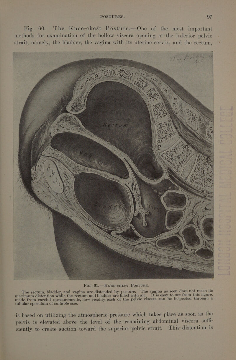 Fig. 60. The Knee-chest Posture.—One of the ‘most important methods for examination of the hollow viscera opening at the inferior pelvic strait, namely, the bladder, the vagina with its uterine cervix, and the rectum, is based on utilizing the atmospheric pressure which takes place as soon as the pelvis is elevated above the level of the remaining abdominal viscera sufhi- ciently to create suction toward the superior pelvic strait. This distention 1s