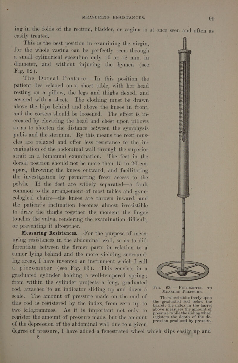 MEASURING RESISTANCES. easily treated. This is the best position in examining the virgin, for the whole vagina can be perfectly seen. through a small cylindrical speculum only 10 or 12 mm. in diameter, and without injuring the hymen (see Fig. 62). The Dorsal Posture.—In this position the patient lies relaxed on a short table, with her head resting on a pillow, the legs and thighs flexed, and covered with a sheet. The clothing must be drawn above the hips behind and above the knees in front, and the corsets should be loosened. The effect is in- ereased by elevating the head and chest upon pillows so as to shorten the distance between the symphysis pubis and the sternum. By this means the recti mus- cles are relaxed and offer less resistance to the in- vagination of the abdominal wall through the superior strait in a bimanual examination. The feet in the dorsal position should not be more than 15 to 20 em. apart, throwing the knees outward, and _ facilitating the investigation by permitting freer access to the pelvis. If the feet are widely separated—a fault common to the arrangement -of most tables and gyne- cological chairs—the knees are thrown inward, and the patient’s inclination becomes almost. irresistible to draw the thighs together the moment the finger touches the vulva, rendering the examination difficult, or preventing it altogether. Measuring Resistances.—I*or the purpose of meas- uring resistances in the abdominal wall, so as to dif- ferentiate between the firmer parts in relation to a tumor lying behind and the more yielding surround- ing areas, I have invented an instrument which I eall a piezometer (see Fig. 63). ‘This consists in a graduated cylinder holding a well-tempered spring; from within the cylinder projects a long, graduated rod, attached to an indicator sliding up and down a scale. The amount of pressure made on the end of this rod is registered by the index, from zero up to two kilogrammes. As it is important not only to of the depression of the abdominal wall due to a given Fig. 63. — PIEZOMETER TO MEASURE PRESSURE. The wheel slides freely upon the graduated rod below the barrel; the index in the barrel above measures the amount of pressure, while the sliding wheel registers the depth of the de- pression produced by pressure. 8