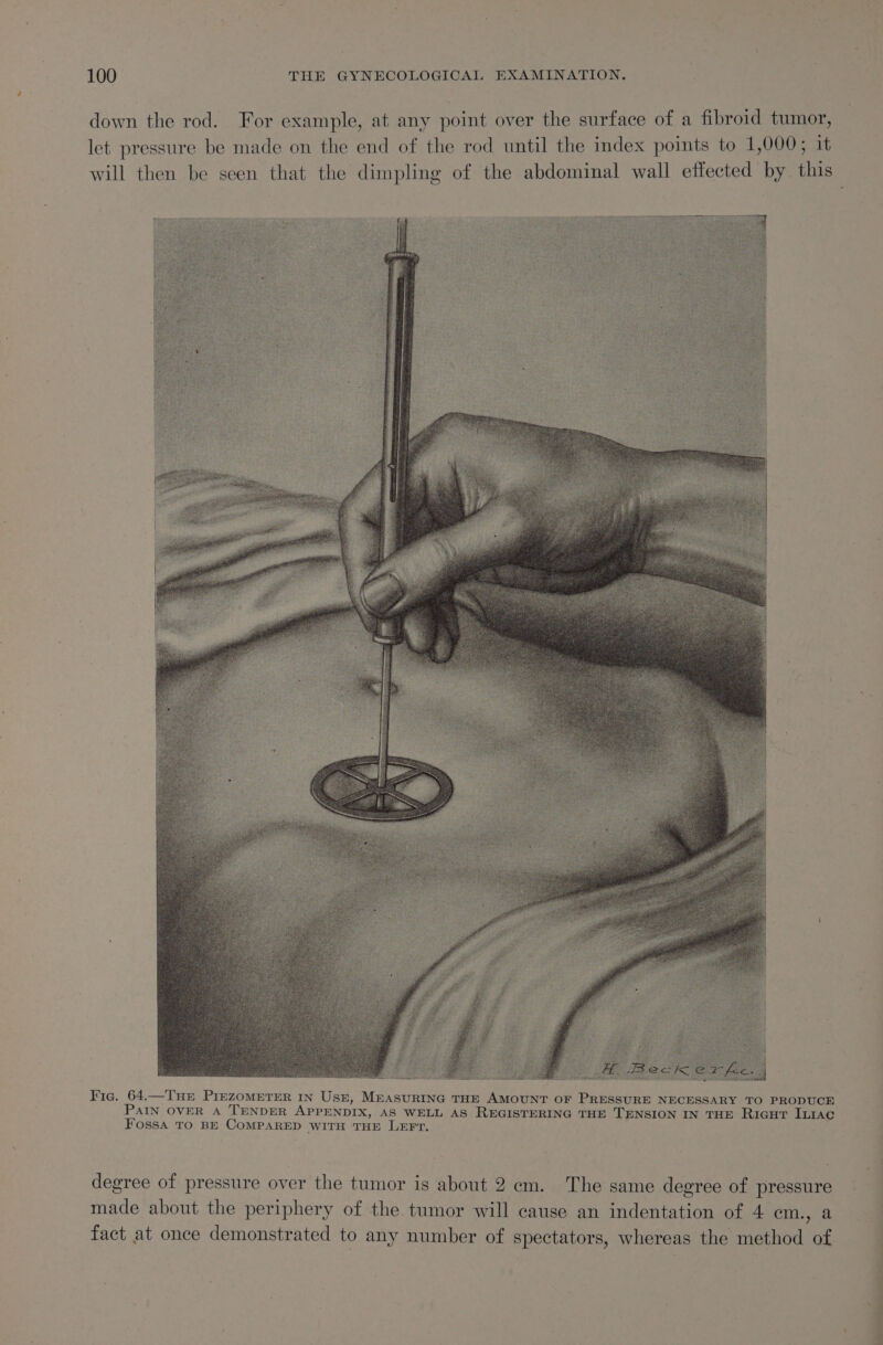 down the rod. For example, at any point over the surface of a fibroid tumor, let pressure be made on the end of the rod until the index points to 1,000; it will then be seen that the dimpling of the abdominal wall effected by this Fic. 64.—Tur PiezoMeTER IN Usz, MEASURING THE AMOUNT OF PRESSURE NECESSARY TO PRODUCE PAIN OVER A TENDER APPENDIX, AS WELL AS REGISTERING THE TENSION IN THE RicuT ILr1ac Fossa TO BE COMPARED WITH THE LEFT. degree of pressure over the tumor is about 2 em. The same degree of pressure made about the periphery of the tumor will cause an indentation of 4 em., a fact at once demonstrated to any number of spectators, whereas the method of