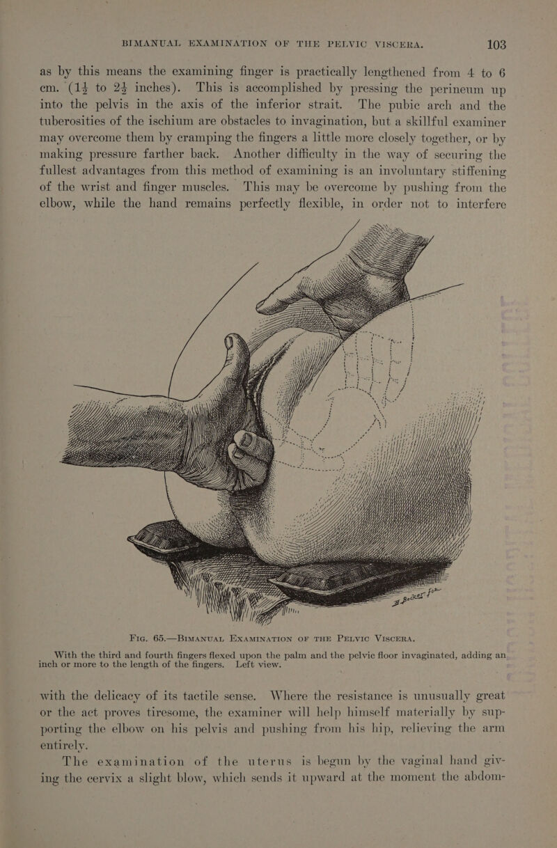 as by this means the examining finger is practically lengthened from 4 to 6 em. (13 to 23 inches). This is accomplished by pressing the perineum up into the pelvis in the axis of the inferior strait. The pubic arch and the tuberosities of the ischium are obstacles to invagination, but a skillful examiner may overcome them by cramping the fingers a little more closely together, or by making pressure farther back. Another difficulty in the way of securing the fullest advantages from this method of examining is an involuntary stiffening of the wrist and finger muscles. This may be overcome by pushing from the elbow, while the hand remains perfectly flexible, in order not to interfere SS SASS SS S iif: SSS S Fig. 65.—BimanuaL EXAMINATION OF THE PELVIC VISCERA. With the third and fourth fingers flexed upon the palm and the pelvic floor invaginated, adding an inch or more to the length of the fingers. Left view. with the delicacy of its tactile sense. Where the resistance is unusually great or the act proves tiresome, the examiner will help himself materially by sup- porting the elbow on his pelvis and pushing from his hip, relieving the arm entirely. | The examination of the uterus is begun by the vaginal hand giv- ing the cervix a slight blow, which sends it upward at the moment the abdom-