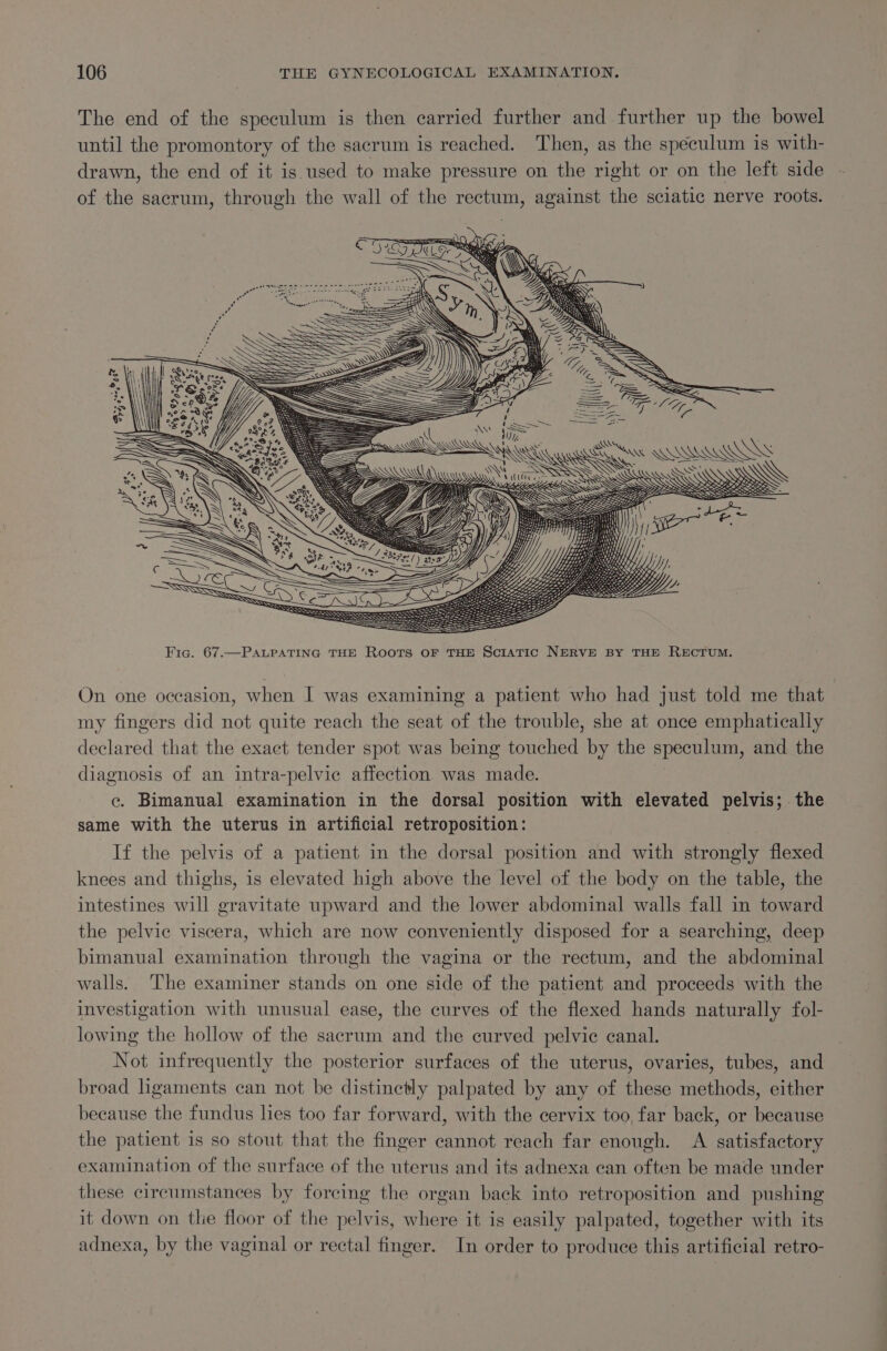 The end of the speculum is then carried further and further up the bowel until the promontory of the sacrum is reached. Then, as the speculum is with- drawn, the end of it is used to make pressure on the right or on the left side of the sacrum, through the wall of the rectum, against the sciatic nerve roots. = &gt; E ‘ ~ WW oy SITES WS SS SS = oR SER : ‘ = SS Bee LIKE RS WSS SS Fig. 67.—PALPATING THE Roots OF THE Sciatic NERVE BY THE RECTUM. On one occasion, when I was examining a patient who had just told me that my fingers did not quite reach the seat of the trouble, she at once emphatically declared that the exact tender spot was being touched by the speculum, and the diagnosis of an intra-pelvie affection. was made. ce. Bimanual examination in the dorsal position with elevated pelvis; the. same with the uterus in artificial retroposition: If the pelvis of a patient in the dorsal position and with strongly flexed knees and thighs, is elevated high above the level of the body on the table, the intestines will gravitate upward and the lower abdominal walls fall in toward the pelvic viscera, which are now conveniently disposed for a searching, deep bimanual examination through the vagina or the rectum, and the abdominal walls. ‘The examiner stands on one side of the patient and proceeds with the investigation with unusual ease, the curves of the flexed hands naturally fol- lowing the hollow of the sacrum and the curved pelvic canal. , Not infrequently the posterior surfaces of the uterus, ovaries, tubes, and broad hgaments can not be distinctly palpated by any of these methods, either because the fundus lies too far forward, with the cervix too far back, or because the patient is so stout that the finger cannot reach far enough. A satisfactory examination of the surface of the uterus and its adnexa can often be made under these circumstances by forcing the organ back into retroposition and pushing it down on the floor of the pelvis, where it is easily palpated, together with its adnexa, by the vaginal or rectal finger. In order to produce this artificial retro-