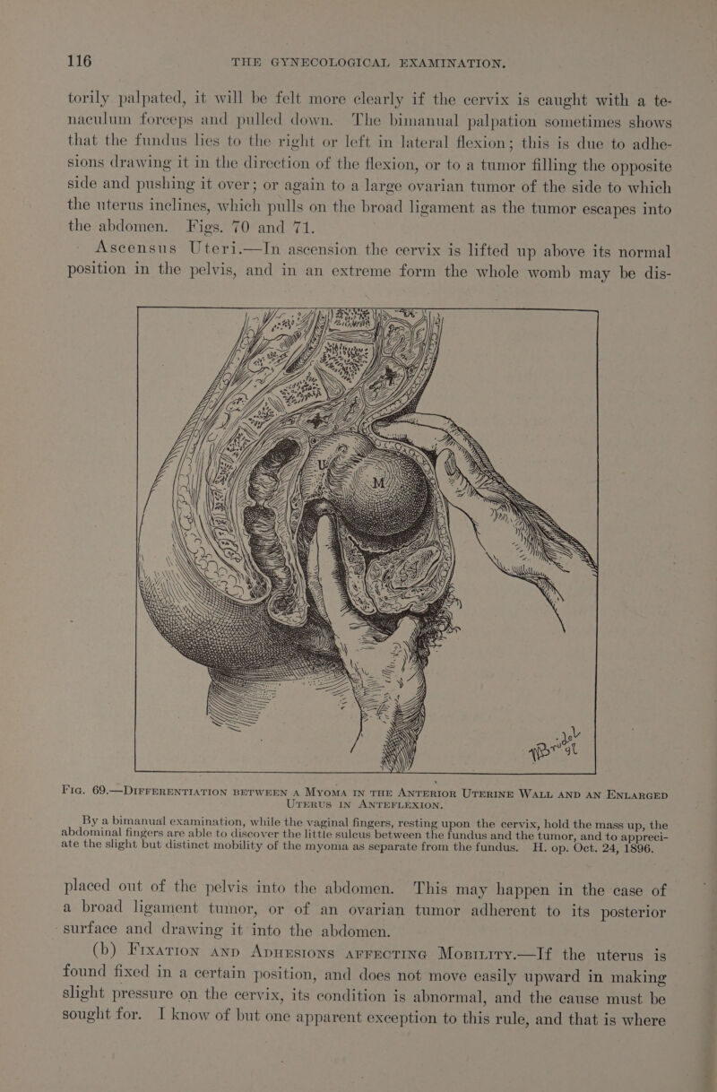 torily palpated, it will be felt more clearly if the cervix is caught with a te- naculum forceps and pulled down. The bimanual palpation sometimes shows that the fundus les to the right or left in lateral flexion; this is due to adhe- sions drawing it in the direction of the flexion, or to a tumor filling the opposite side and pushing it over; or again to a large ovarian tumor of the side to which the uterus inclines, which pulls on the broad ligament as the tumor escapes into the abdomen. Figs. 70 and 71. Ascensus Uteri.—In ascension the cervix is lifted up above its normal position in the pelvis, and in an extreme form the whole womb may be dis- &gt; OH v Pr on un? Pe a, { ii iy va Ah 7S Up Apv ys er Ly | a A : Cy ‘ “J Kr YY a ING ‘ “f Na i Mi, * iy | A a Ge a4 ZZ ey Cc ey a Tia. 69.—DIFFERENTIATION BETWEEN A MYOMA IN THE ANTERIOR UTERINE WALL AND AN ENLARGED UTERUS IN ANTEFLEXION. By a bimanual examination, while the vaginal fingers, resting upon the cervix, hold the mass up, the abdominal fingers are able to discover the little sulcus between the fundus and the tumor, and to appreci- ate the slight but distinct mobility of the myoma as separate from the fundus. H. op. Oct. 24, 1896. placed out of the pelvis into the abdomen. This may happen in the case of a broad ligament tumor, or of an ovarian tumor adherent to its posterior ‘surface and drawing it into the abdomen. (b) Frxarion ann Apnestons arrectine Mosriiry.—If the uterus is found fixed in a certain position, and does not move easily upward in making slight pressure on the cervix, its condition is abnormal, and the cause must be sought for. I know of but one apparent exception to this rule, and that is where