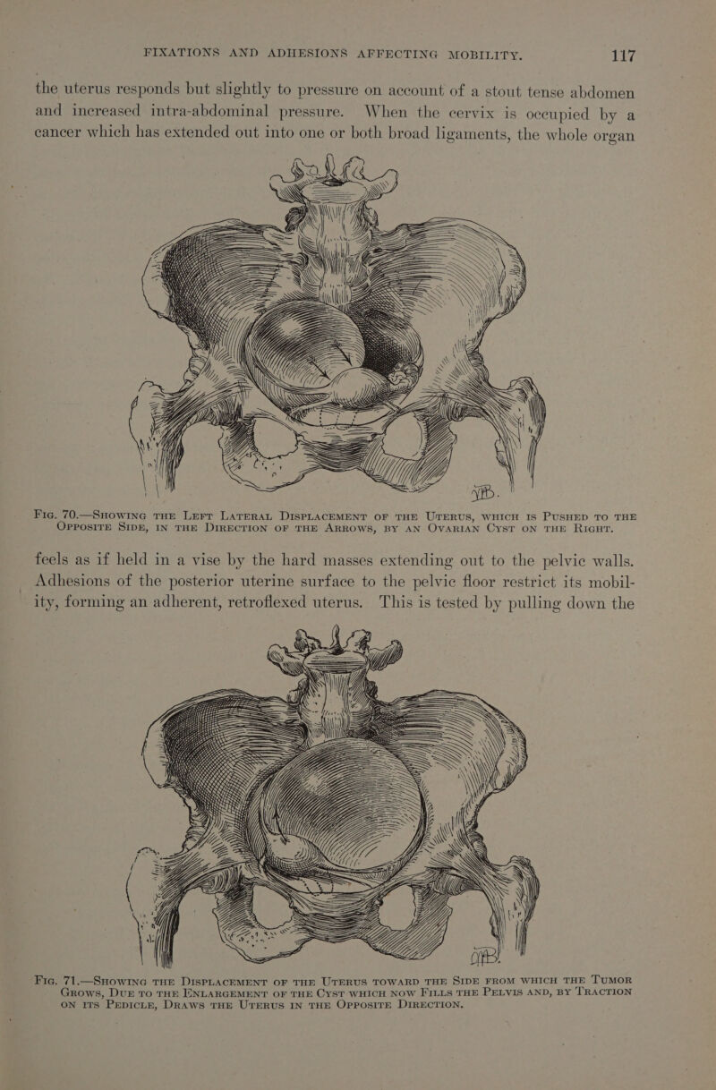 the uterus responds but slightly to pressure on account of a stout tense abdomen and increased intra-abdominal pressure. When the cervix is occupied by a eancer which has extended out into one or both broad ligaments, the whole organ A; Nh 4 fesse ia AS = WQ\’Y=|= YS Fie. 70.—Snowine THE Lerr LATERAL DISPLACEMENT OF THE UTERUS, WHICH IS PUSHED TO THE OpposiTE SIDE, IN THE DIRECTION OF THE ARROWS, BY AN OVARIAN Cys? ON THE RIGHT. feels as if held in a vise by the hard masses extending out to the pelvic walls. Adhesions of the posterior uterine surface to the pelvic floor restrict its mobil- ity, forming an adherent, retroflexed uterus. This is tested by pulling down the Fig. 71.—SHowine THE DISPLACEMENT OF THE UTERUS TOWARD THE SIDE FROM WHICH THE TUMOR Grows, Dur To THE ENLARGEMENT OF THE CYST WHICH NOW FILLS THE PELVIS AND, BY TRACTION ON ITS PepicLtE, Draws THE UTERUS IN THE OpposiITE DIRECTION.