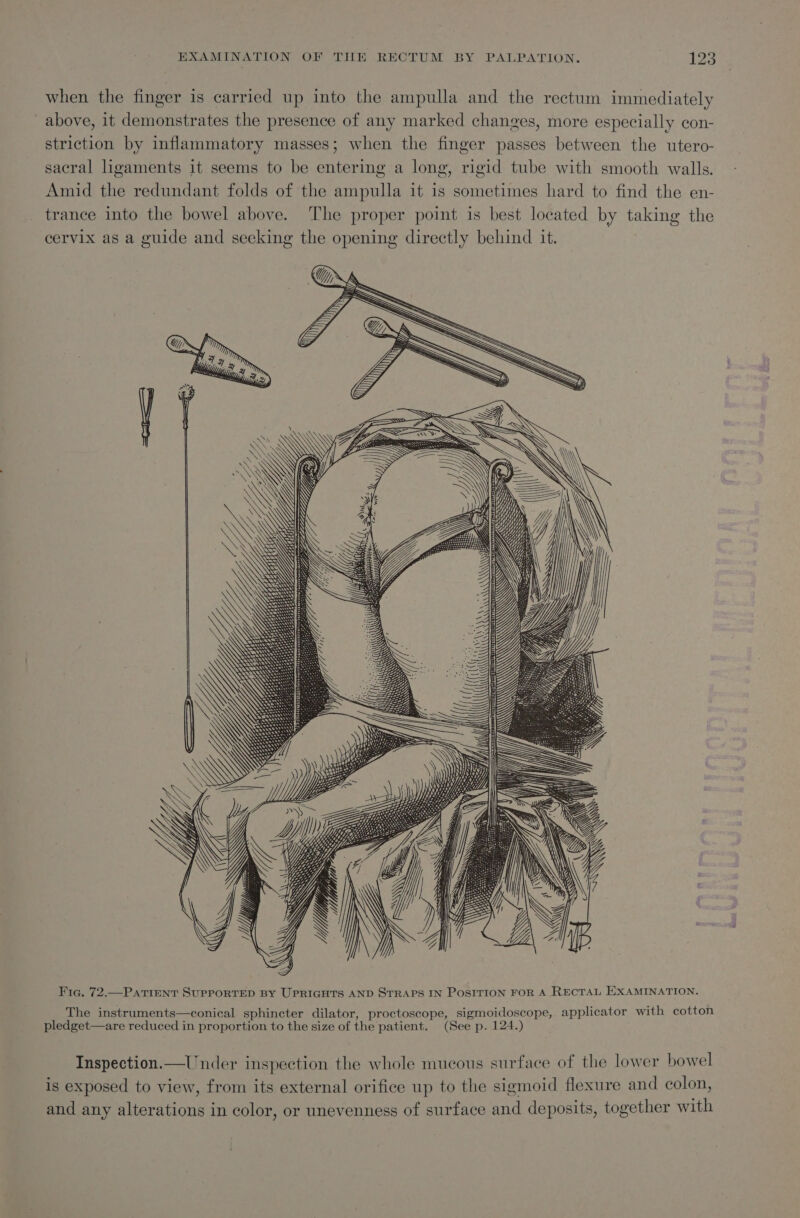when the finger is carried up into the ampulla and the rectum immediately above, it demonstrates the presence of any marked changes, more especially con- striction by inflammatory masses; when the finger passes between the utero- sacral hgaments it seems to be entering a long, rigid tube with smooth walls. Amid the redundant folds of the ampulla it is sometimes hard to find the en- trance into the bowel above. The proper point is best located by taking the cervix as a guide and seeking the opening directly behind it. =A &lt;&lt; } SS RS LRTI TPNT ITT] SS SSS Fic. 72.—PatTient SuPPORTED BY UPRIGHTS AND STRAPS IN PosITION FOR A RECTAL EXAMINATION. The instruments—conical sphincter dilator, proctoscope, sigmoidoscope, applicator with cotton pledget—are reduced in proportion to the size of the patient. (See p. 124.) Inspection.—Under inspection the whole mucous surface of the lower bowel is exposed to view, from its external orifice up to the sigmoid flexure and colon, and any alterations in color, or unevenness of surface and deposits, together with