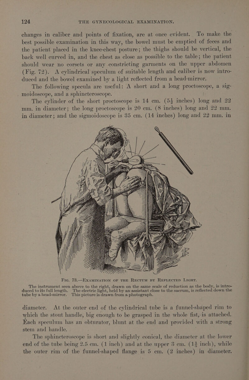 changes in caliber and points of fixation, are at once evident. To make the best possible examination in this way, the bowel must be emptied of feces and the patient placed in the knee-chest posture; the thighs should be vertical, the back well curved in, and the chest as close as possible to the table; the patient should wear no corsets or any constricting garments on the upper abdomen (Fig. 72). &lt;A eylindrical speculum of suitable length and caliber is now intro- duced and the bowel examined by a light reflected from a head-mirror. The following specula are useful: A short and a long proctoscope, a sig- moidoscope, and a sphincteroscope. The cylinder of the short proctoscope is 14 em. (5% inches) long and 22 mm. in diameter; the long proctoscope is 20 em. (8 inches) long and 22 mm. in diameter; and the sigmoidoscope is 85 em. (14 inches) long and 22 mm. in a =&lt;—S SLE TSS Fic. 73.—EXAMINATION OF THE RECTUM BY REFLECTED LIGHT. The instrument seen above to the right, drawn on the same scale of reduction as the body, is intro- duced to its full length. The electric light, held by an assistant close to the sacrum, is reflected down the tube by a head-mirror. This picture is drawn from a photograph. diameter. At the outer end of the cylindrical tube is a funnel-shaped rim to which the stout handle, big enough to be grasped in the whole fist, is attached. Each speculum has an obturator, blunt at the end and provided with a strong stem and handle. . | The sphincteroscope is short and slightly conical, the diameter at the lower end of the tube being 2.5 em. (1 inch) and at the upper 3 em. (14 inch), while the outer rim of the funnel-shaped flange is 5 em. (2 inches) in diameter.