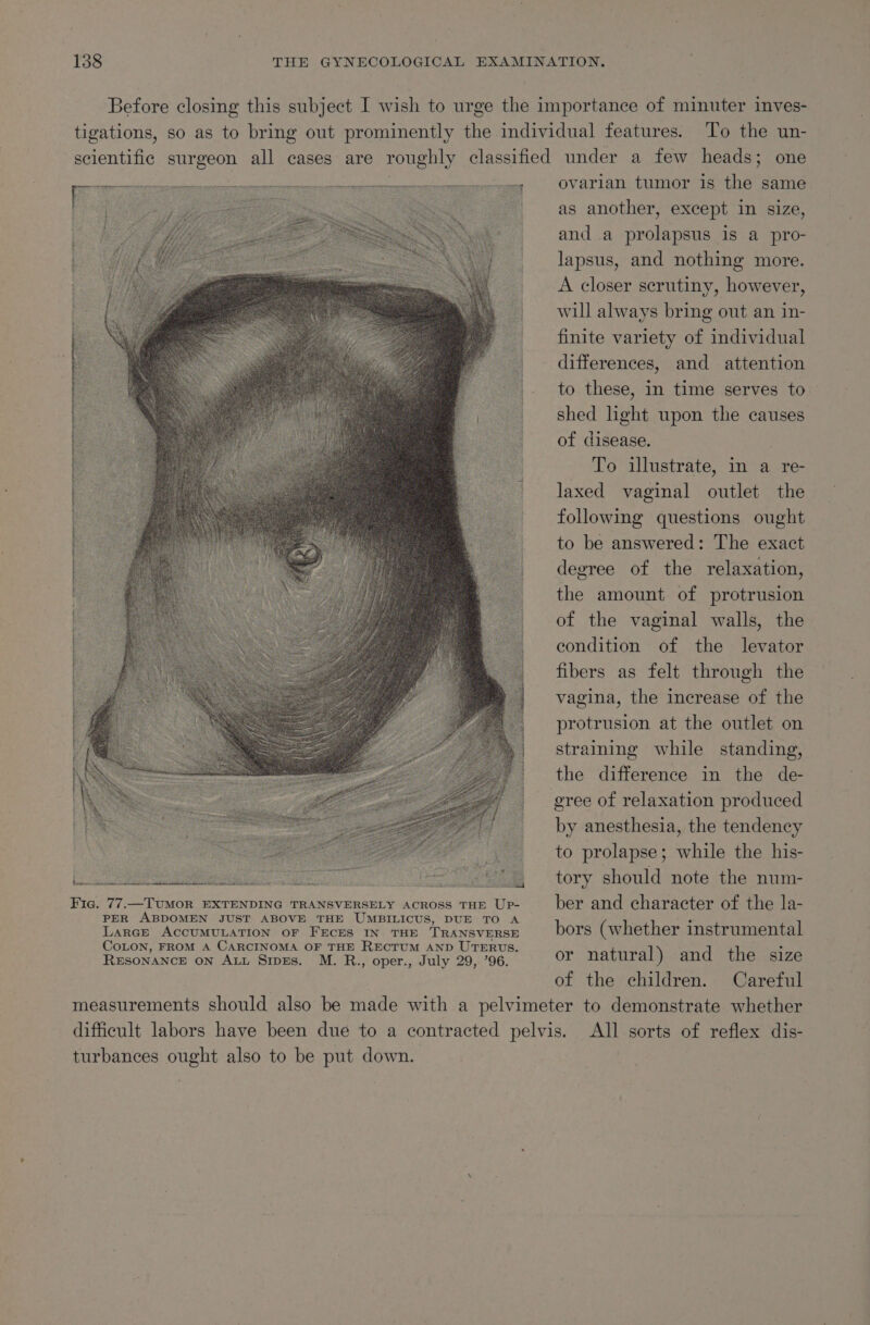 Fic. 77.—TUMOR EXTENDING TRANSVERSELY ACROSS THE UP- PER ABDOMEN JUST ABOVE THE UMBILICUS, DUE TO A Larce ACCUMULATION OF FECES IN THE TRANSVERSE COLON, FROM A CARCINOMA OF THE RECTUM AND UTERUS. RESONANCE on ALL Stpes. M. R., oper., July 29, ’96. ovarian tumor is the same as another, except in size, and a prolapsus is a pro- lapsus, and nothing more. A closer scrutiny, however, will always bring out an in- finite variety of individual differences, and attention to these, in time serves to shed hght upon the causes of disease. To illustrate, in a re- laxed vaginal outlet the following questions ought to be answered: The exact degree of the relaxation, the amount of protrusion of the vaginal walls, the condition of the levator fibers as felt through the vagina, the increase of the protrusion at the outlet on straining while standing, the difference in the de- by anesthesia, the tendency to prolapse; while the his- tory should note the num- ber and character of the la- bors (whether instrumental or natural) and the size of the children. Careful turbances ought also to be put down.
