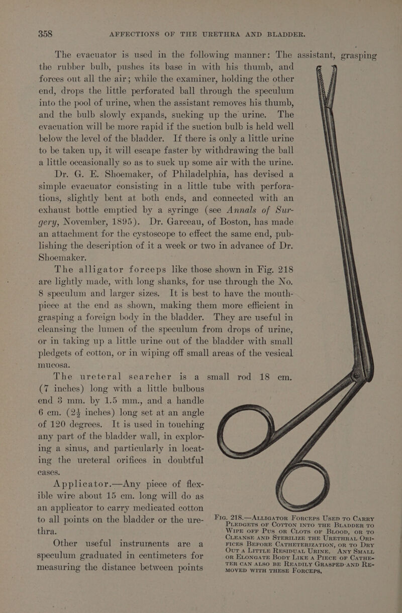 The evacuator is used in the following manner: The assistant, grasping the rubber bulb, pushes its base in with his thumb, and | forces out all the air; while the examiner, holding the other end, drops the little perforated ball through the speculum into the pool of urine, when the assistant removes his thumb, and the bulb slowly expands, sucking up the urine. The evacuation will be more rapid if the suction bulb is held well below the level of the bladder. If there is only a little urine to be taken up, it will escape faster by withdrawing the ball a little occasionally so as to suck up some air with the urine. Dr. G. E. Shoemaker, of Philadelphia, has devised a simple evacuator consisting in a little tube with perfora- tions, slightly bent at both ends, and connected with an exhaust bottle emptied by a syringe (see Annals of Sur- gery, November, 1895). Dr. Garceau, of Boston, has made an attachment for the cystoscope to effect the same end, pub- lishing the description of it a week or two in advance of Dr. Shoemaker. | The alligator forceps lke those shown in Fig. 218 are lightly made, with long shanks, for use through the No. 8 speculum and larger sizes. It is best to have the mouth- piece at the end as shown, making them more efficient in erasping a foreign body in the bladder. They are useful in cleansing the lumen of the speculum from drops of urine, or in taking up a little urime out of the bladder with small pledgets of cotton, or in wiping off small areas of the vesical mucosa. | The ureteral searcher is a small rod 18 em. (7 inches) long with a little bulbous end 38 mm. by 1.5 mm., and a handle 6 cm. (24 inches) long set at an angle of 120 degrees. It is used in touching any part of the bladder wall, in explor- ing a sinus, and particularly in locat- ing the ureteral orifices in doubtful cases. Applicator.—Any piece of flex- ible wire about 15 cm. long will do as an applicator to carry medicated cotton to all points on the bladder or the ure- Fig. 218.—Atiigator Forcers Usep ro Carry PLEDGETS OF COTTON INTO THE BLADDER TO thra. WIPE orFr Pus or CLots or BLoop, oR TO ; CLEANSE AND STERILIZE THE URETHRAL ORI- Other useful instruments are a FICES BEFORE CATHETERIZATION, OR TO Dry 3 4 Out A LirrLte Resipuat URINE. ANY SMALL speculum eraduated in centimeters for oR ELoNGATE Bopy LIkE A PIECE oF CATHE- : . . TER CAN ALSO BE READILY GRASPED:AND RE- measuring the distance between points MOVED WITH THESE FORCEPS,