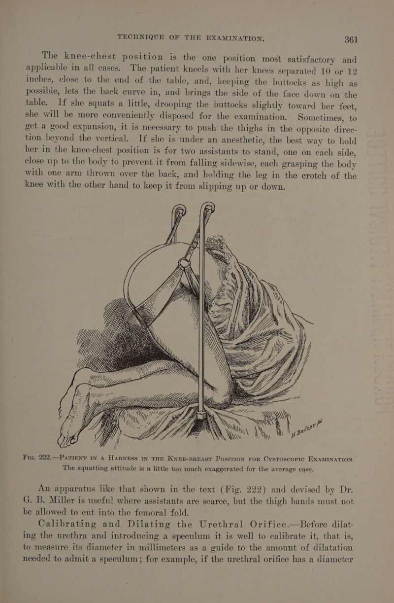 The knee-chest position is the one position most satisfactory and applicable in all cases. The patient kneels with her knees separated 10 or 12 inches, close to the end of the table, and, keeping the buttocks as high as possible, lets the back curve in, and brings the side of the face down on the table. If she squats a little, drooping the buttocks slightly toward her feet, she will be more conveniently disposed for the examination. Sometimes, to get a good expansion, it is necessary to push the thighs in the opposite direc- tion beyond the vertical. If she is under an anesthetic, the best way to hold her in the knee-chest position is for two assistants to stand, one on each side, close up to the body to prevent it from falling sidewise, each grasping the body with one arm thrown over the back, and holding the leg in the crotch of the knee with the other hand to keep it from slipping up or down. Yi ——~ YUflite. (My ili LLALA YY Lf | Fig. 222.—PaTiENT In A HARNESS IN THE KNEE-BREAST PosrTION FOR CysToscoPpic EXAMINATION, The squatting attitude is a little too much exaggerated for the average case. An apparatus like that shown in the text (Fig. 222) and devised by Dr. G. B. Miller is useful where assistants are scarce, but the thigh bands must not be allowed to cut into the femoral fold. Calibrating and Dilating the Urethral Orifice.—Before dilat- ing the urethra and introducing a speculum it is well to calibrate it, that is, to measure its diameter in millimeters as a guide to the amount of dilatation needed to admit a speculum; for example, if the urethral orifice has a diameter