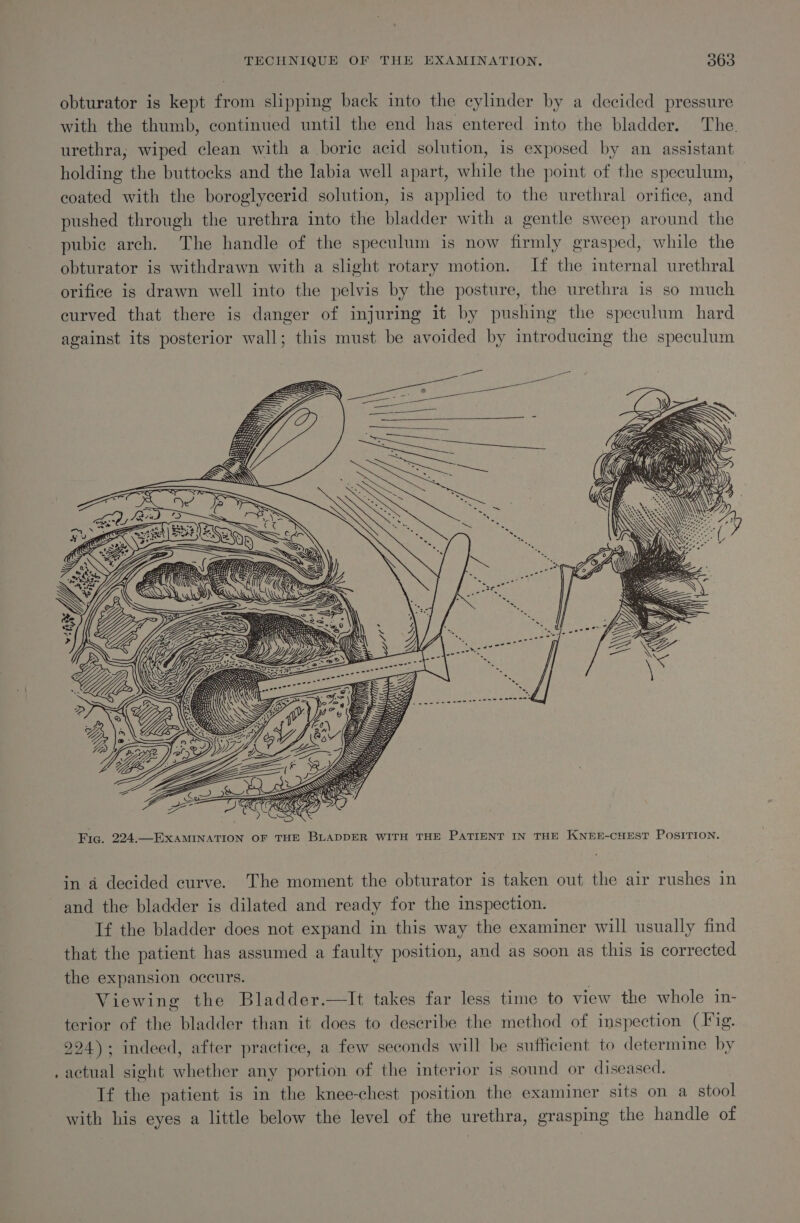 obturator is kept from slipping back into the cylinder by a decided pressure with the thumb, continued until the end has entered into the bladder. The. urethra, wiped clean with a boric acid solution, is exposed by an assistant holding the buttocks and the labia well apart, while the point of the speculum, coated with the boroglycerid solution, is applied to the urethral orifice, and pushed through the urethra into the bladder with a gentle sweep around the pubic arch. The handle of the speculum is now firmly grasped, while the obturator is withdrawn with a slight rotary motion. If the internal urethral orifice is drawn well into the pelvis by the posture, the urethra is so much curved that there is danger of injuring it by pushing the speculum hard against its posterior wall; this must be avoided by introducing the speculum 8) | yy mts lhe ANS Fig. 224.—EXAMINATION OF THE BLADDER WITH THE PATIENT IN THE KNEE-CHEST POSITION. in a decided curve. The moment the obturator is taken out the air rushes in and the bladder is dilated and ready for the inspection. If the bladder does not expand in this way the examiner will usually find that the patient has assumed a faulty position, and as soon as this is corrected the expansion occurs. Viewing the Bladder.—lIt takes far less time to view the whole in- terior of the bladder than it does to describe the method of inspection (Fig. 224): indeed, after practice, a few seconds will be sufficient to determine by actual sight whether any portion of the interior is sound or diseased. If the patient is in the knee-chest position the examiner sits on a stool with his eyes a little below the level of the urethra, grasping the handle of