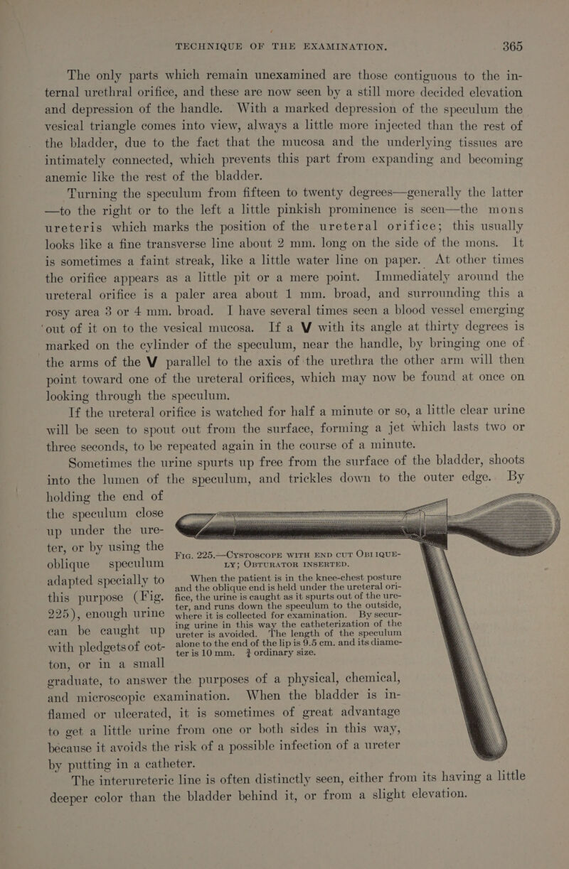 The only parts which remain unexamined are those contiguous to the in- ternal urethral orifice, and these are now seen by a still more decided elevation and depression of the handle. With a marked depression of the speculum the vesical triangle comes into view, always a little more injected than the rest of the bladder, due to the fact that the mucosa and the underlying tissues are intimately connected, which prevents this part from expanding and becoming anemic like the rest of the bladder. Turning the speculum from fifteen to twenty degrees—generally the latter —to the right or to the left a little pinkish prominence is seen—the mons ureteris which marks the position of the ureteral orifice; this usually looks like a fine transverse line about 2 mm. long on the side of the mons. It is sometimes a faint streak, like a little water line on paper. At other times the orifice appears as a little pit or a mere point. Immediately around the ureteral orifice is a paler area about 1 mm. broad, and surrounding this a rosy area 3 or 4 mm. broad. I have several times seen a blood vessel emerging ‘out of it on to the vesical mucosa. If a V with its angle at thirty degrees is marked on the cylinder of the speculum, near the handle, by bringing one of the arms of the V parallel to the axis of the urethra the other arm will then point toward one of the ureteral orifices, which may now be found at once on looking through the speculum. If the ureteral orifice is watched for half a minute or so, a little clear urine will be seen to spout out from the surface, forming a jet which lasts two or three seconds, to be repeated again in the course of a minute. Sometimes the urine spurts up free from the surface of the bladder, shoots into the lumen of the speculum, and trickles down to the outer edge. By holding the end of the speculum close up under the ure- ter, or by using the oblique speculum Fic. 225.—CystToscoPE WITH END CUT OBIIQUE- LY; OBTURATOR INSERTED. When the patient is in the knee-chest posture adapted specially to this purpose (Tig. 295), enough urine ean be caught up with pledgetsof cot- ton, or in a small graduate, to answer and the oblique end is held under the ureteral ori- fice, the urine is caught as it spurts out of the ure- ter, and runs down the speculum to the outside, where it is collected for examination. By secur- ing urine in this way the catheterization of the ureter is avoided. The length of the speculum alone to the end of the lip is 9.5 cm. and its diame- teris 10mm. # ordinary size. When the bladder is in-
