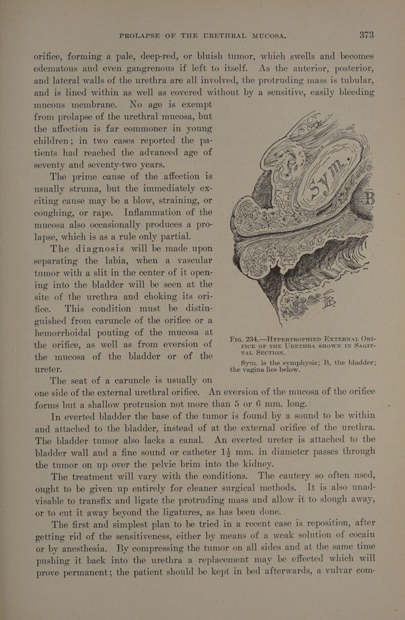 PROLAPSE OF THE URETHRAL MUCOSA. 370 orifice, forming a pale, deep-red, or bluish tumor, which swells and becomes edematous and even gangrenous if left to itself. As the anterior, posterior, and lateral walls of the urethra are all involved, the protruding mass is tubular, and is lined within as well as covered without by a sensitive, easily bleeding mucous membrane. No age is exempt from prolapse of the urethral mucosa, but the affection is far commoner in young children; in two cases reported the pa- tients had reached the advanced age of seventy and seventy-two years. The prime cause of the affection is usually struma, but the immediately ex- citing cause may be a blow, straining, or coughing, or rape. Inflammation of the mucosa also occasionally produces a pro- lapse, which is as a rule only partial. The diagnosis will be made upon separating the labia, when a vascular tumor with a slit in the center of it open- ing into the bladder will be seen at the site of the urethra and choking its ori- fice. This condition must be distin- guished from earuncle of the orifice or a hemorrhoidal pouting of the mucosa at } Fig. 234.—HyperRTROPHIED EXTERNAL ORI- the orifice, as well as from eversion of Pe a oe own Su cai the mucosa of the bladder or of the pe eee ON, _ Sym. is the symphysis; B, the bladder; uMrever. the vagina lies below. The seat of a caruncle is usually on one side of the external urethral orifice. An eversion of the mucosa of the orifice forms but a shallow protrusion not more than 5 or 6 mm. long. In everted bladder the base of the tumor is found by a sound to be within and attached to the bladder, instead of at the external orifice of the urethra. The bladder tumor also lacks a canal. An everted ureter is attached to the bladder wall and a fine sound or catheter 14 mm. in diameter passes through the tumor on up over the pelvic brim into the kidney. The treatment will vary with the conditions. The cautery so often used, ought to be given up entirely for cleaner surgical methods. It is also unad- visable to transfix and ligate the protruding mass and allow it to slough away, or to cut it away beyond the ligatures, as has been done. | The first and simplest plan to be tried in a recent case is reposition, after getting rid of the sensitiveness, either by means of a weak solution of cocain or by anesthesia. By compressing the tumor on all sides and at the same time pushing it back into the urethra a replacement may be effected which will prove permanent; the patient should be kept in bed afterwards, a vulvar com-