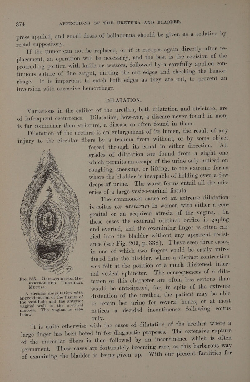 press applied, and small doses of belladonna should be given as a sedative by rectal suppository. If the tumor can not be replaced, or if it escapes again directly after re- placement, an operation will be necessary, and the best is the excision of the protruding portion with knife or scissors, followed by a carefully applied con- tinuous suture of fine catgut, uniting the cut edges and checking the hemor- rhage. It is important to catch both edges as they are cut, to prevent an inversion with excessive hemorrhage. DILATATION. Variations in the caliber of the urethra, both dilatation and stricture, are of infrequent occurrence. Dilatation, however, a disease never found in men, ‘5 far commoner than stricture, a disease so often found in them. Dilatation of the urethra is an enlargement of its lumen, the result of any injury to the circular fibers by a trauma from without, or by some object forced through its canal in either direction. All erades of dilatation are found from a slight one which permits an escape of the urine only noticed on coughing, sneezing, or lifting, to the extreme forms where the bladder is incapable of holding even a few drops of urine. The worst, forms entail all the mis- eries of a large vesico-vaginal fistula. The commonest cause of an extreme dilatation is coitus per urethram in women with either a con- genital or an acquired atresia of the vagina. In these cases the external urethral orifice is gaping and everted, and the examining finger is often ear- ried into the bladder without any apparent resist- ance (sce Fig. 209, p. 3388). I have seen three cases, in one of which two fingers could be easily mtro- duced into the bladder, where a distinct contraction was felt at the position of a much thickened, inter- nal vesical sphincter. The consequences of a dila- Fic. 235.—OPERATION For Hy- ; ; : oP sears Uneiikad tation of this. character are Olen less serious than meee Vai: would be anticipated, for, in spite of the extreme A circular amputation with J ‘ ‘ approximation of the tissues of distention of the urethra, the patient may be able aan Se eS to retain her urine for several hours, or at most area The vagina is seen yotices a decided ineontinence following coitus only. It is quite otherwise with the cases of dilatation of the urethra where a large finger has been bored in for diagnostic purposes. The extensive rupture of the muscular fibers is then followed by an incontinence which is often permanent. ‘These cases are fortunately becoming rare, as this barbarous way of examining the bladder is being given up. With our present facilities for x ‘