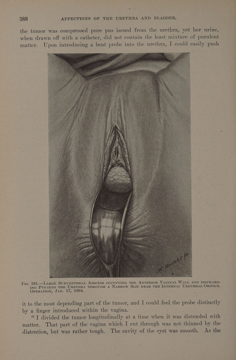 the tumor was compressed pure pus issued from the urethra, yet her urine, when drawn off with a catheter, did not contain the least mixture of purulent matter. Upon introducing a bent probe into the urethra, I could easily push Fic, 241.—Larcr SUBURETHRAL ABSCESS OCCUPYING THE ANTERIOR VAGINAL WALL AND DISCHARG- Inc PusINTO THE URETHRA THROUGH A NARROW SLIT NEAR THE INTERNAL URETHRAL ORIFICE. OPERATION, JAN. 17, 1894. it to the most depending part of the tumor, and I could feel the probe distinctly by a finger introduced within the vagina. “T divided the tumor longitudinally at a time when it was distended with matter. That part of the vagina which I cut through was not thinned by the distention, but was rather tough. The cavity of the cyst was smooth. As the