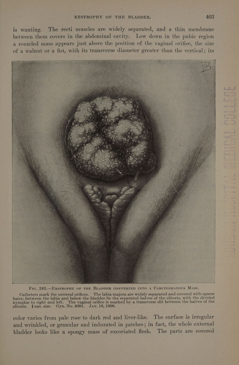 Fig. 243.—ExsTROPHY OF THE BLADDER CONVERTED INTO A CARCINOMATOUS MASss. Catheters mark the ureteral orifices. The labia majora are widely separated and covered with sparse hairs; between the labia and below the bladder lie the separated halves of the clitoris, with the divided nymphe to right and left. _The vaginal orifice is marked by a transverse slit between the halves of the clitoris. nat. size. Gyn. No. 4091. Jan. 18, 1896. color varies from pale rose to dark red and liver-like. The surface is irregular and wrinkled, or granular and indurated in patches; in fact, the whole external bladder looks like a spongy mass of excoriated flesh. The parts are covered