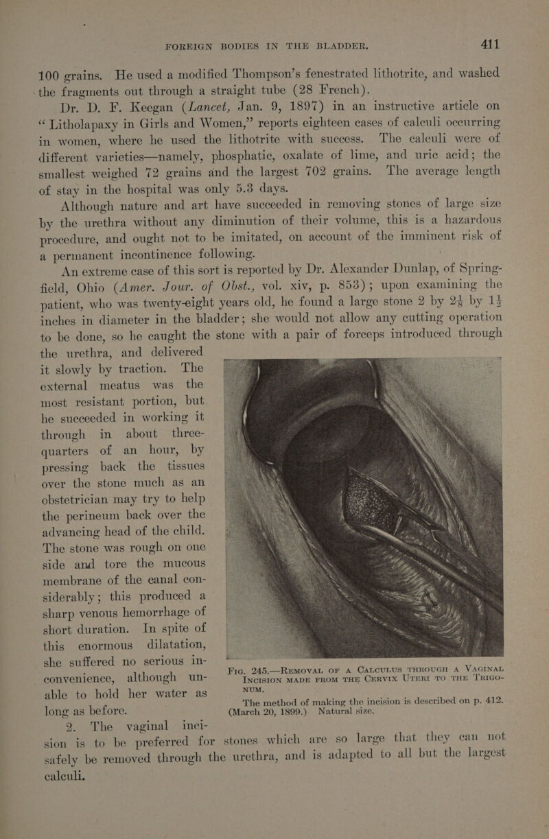 100 grains. He used a modified Thompson’s fenestrated lithotrite, and washed -the fragments out through a straight tube (28 French). Dr. D. F. Keegan (Lancet, Jan. 9, 1897) in an instructive article on “ Litholapaxy in Girls and Women,” reports eighteen cases of calculi occurring in women, where he used the lithotrite with success. The caleuli were of different varieties—namely, phosphatic, oxalate of lime, and uric acid; the smallest weighed 72 grains and the largest 702 grains. The average length of stay in the hospital was only 5.3 days. Although nature and art have succeeded in removing stones of large size by the urethra without any diminution of their volume, this is a hazardous procedure, and ought not to be imitated, on account of the imminent risk of a permanent incontinence following. An extreme case of this sort is reported by Dr. Alexander Dunlap, of Spring- field, Ohio (Amer. Jour. of Obst., vol. xiv, p. 853); upon examining the patient, who was twenty-eight years old, he found a large stone 2 by 24 by 13 inches in diameter in the bladder; she would not allow any cutting operation to be done, so he caught the stone with a pair of forceps introduced through the urethra, and delivered it slowly by traction. The external meatus was the most resistant portion, but he succeeded in working it through in about three- quarters of an hour, by pressing back the tissues over the stone much as an obstetrician may try to help the perineum back over the advancing head of the child. The stone was rough on one side and tore the mucous membrane of the canal con- siderably; this produced a sharp venous hemorrhage of short duration. In spite of this enormous dilatation, she suffered no serious in- Fig. 245.—REMovVAL OF A CALCULUS THROUGH A VAGINAL convenience, although un- INCISION MADE FROM THE CERVIX UTERI TO THE TRIGO- able to hold her water as ey : The method of making the incision is described on p. 412. long as before. (March 20, 1899.). Natural size. 9. The vaginal inci- sion is to be preferred for stones which are so large that they can not safely be removed through the urethra, and is adapted to all but the largest ealeuli.