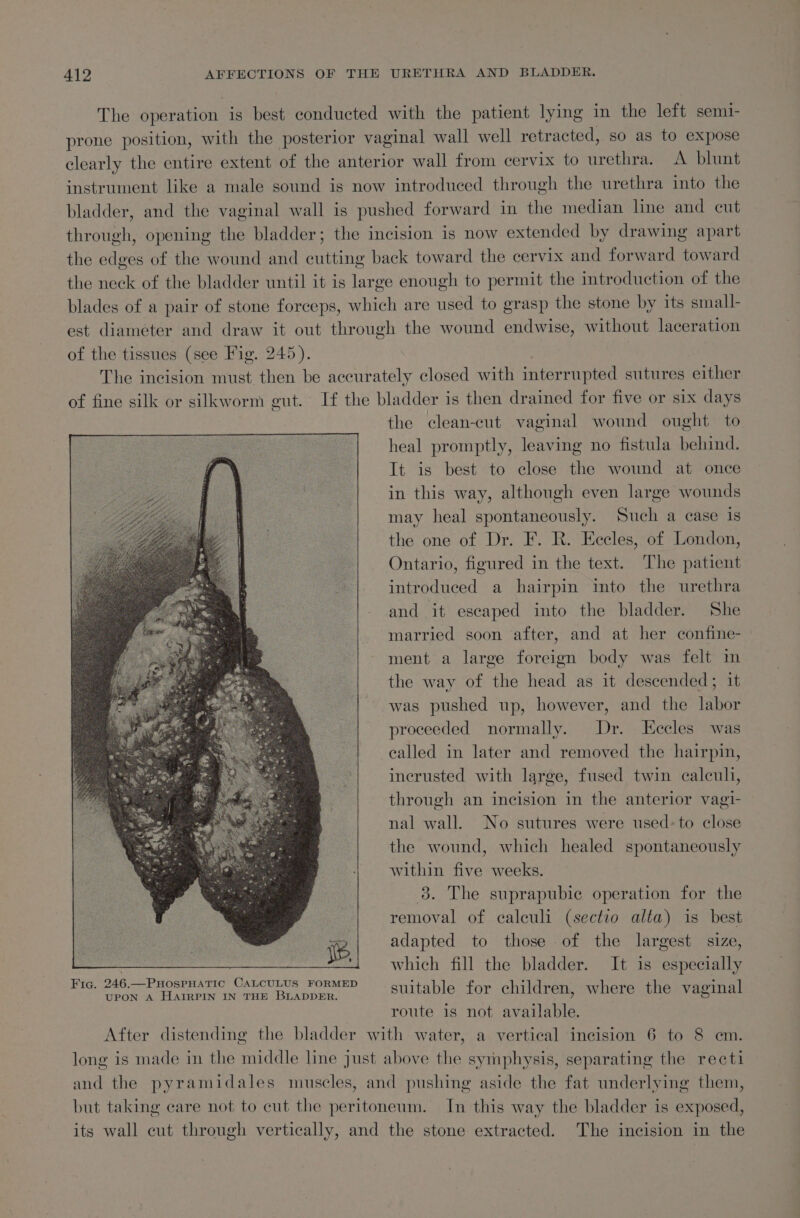 The operation is best conducted with the patient lying in the left semi- prone position, with the posterior vaginal wall well retracted, so as to expose clearly the entire extent of the anterior wall from cervix to urethra. A blunt instrument like a male sound is now introduced through the urethra into the bladder, and the vaginal wall is pushed forward in the median line and cut through, opening the bladder; the incision is now extended by drawing apart the edges of the wound and cutting back toward the cervix and forward toward the neck of the bladder until it is large enough to permit the introduction of the blades of a pair of stone forceps, which are used to grasp the stone by its small- est diameter and draw it out through the wound endwise, without laceration of the tissues (see Fig. 245). The incision must then be accurately closed with interrupted sutures either of fine silk or silkworm gut. If the bladder is then drained for five or six days the clean-cut vaginal wound ought to heal promptly, leaving no fistula behind. It is best to close the wound at once in this way, although even large wounds may heal spontaneously. Such a case is the one of Dr. F. R. Eccles, of London, Ontario, figured in the text. The patient introduced a hairpin into the urethra and it escaped into the bladder. She married soon after, and at her confine- ment a large foreign body was felt in the way of the head as it descended; it was pushed up, however, and the labor proceeded normally. Dr. Eccles was ealled in later and removed the hairpin, incrusted with large, fused twin calcul, through an incision in the anterior vagi- nal wall. No sutures were used: to close the wound, which healed spontaneously within five weeks. 3. The suprapubic operation for the removal of calculi (sectio alta) is best adapted to those of the largest size, which fill the bladder. It is especially suitable for children, where the vaginal route is not available. After distending the bladder with water, a vertical incision 6 to 8 cm. long is made in the middle line just above the symphysis, separating the recti and the pyramidales muscles, and pushing aside the fat underlying them, but taking care not to cut the peritoneum. In this way the bladder is exposed, its wall cut through vertically, and the stone extracted. The incision in the