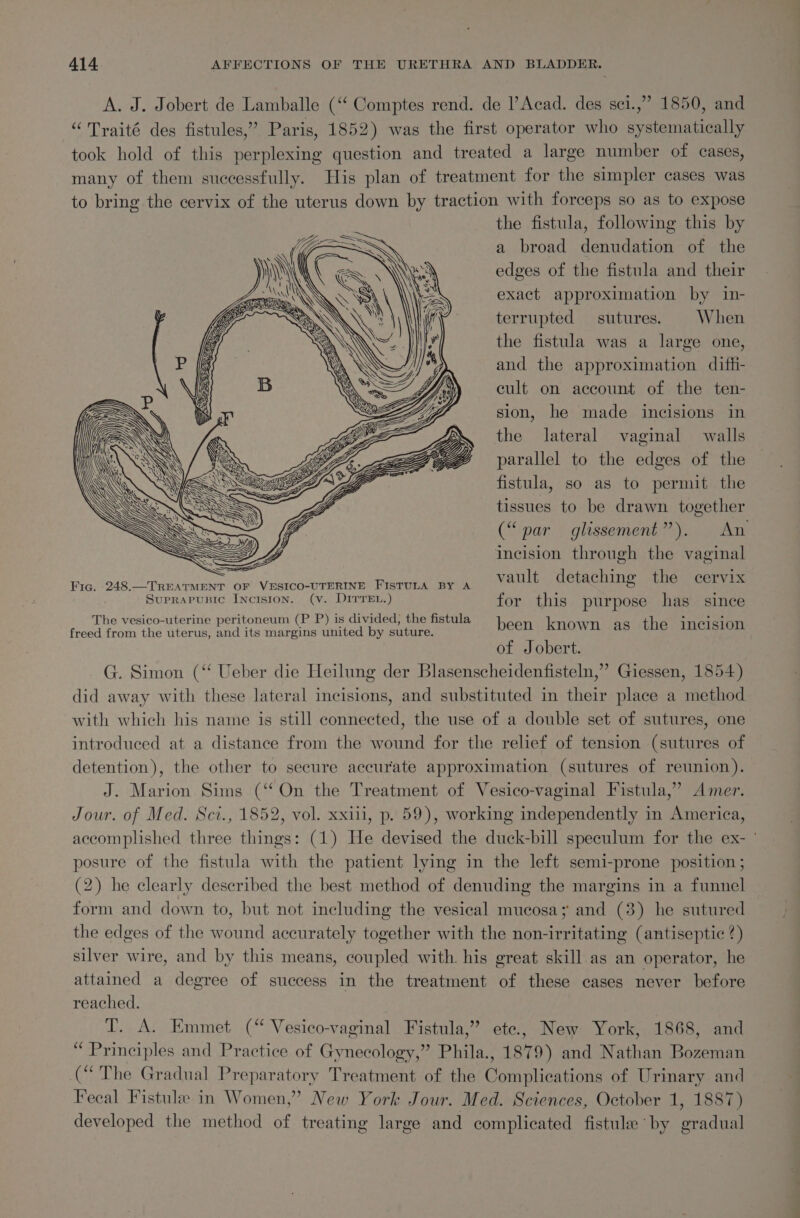 A. J. Jobert de Lamballe (‘‘ Comptes rend. de l’Acad. des sci.,” 1850, and “ Traité des fistules,” Paris, 1852) was the first operator who systematically took hold of this perplexing question and treated a large number of cases, many of them successfully. His plan of treatment for the simpler cases was to bring the cervix of the uterus down by traction with forceps so as to expose the fistula, following this by a broad denudation of the edges of the fistula and their exact approximation by in- terrupted sutures. When the fistula was a large one, and the approximation diffi- cult on account of the ten- sion, he made incisions in the lateral vaginal walls parallel to the edges of the fistula, so as to permit the tissues to be drawn together (“par glissement”). An incision through the vaginal Fia. 248, TREATMENT OF VESICO-UTERINE FISTULA BY A vault detaching the cervix Suprapusic Incision. (v. DITTEL.) for this purpose has. since The vesico-uterine peritoneum (P P) is divided, the fistula u RE! freed from the uterus, and its margins united by suture. been known as the incision of Jobert. G. Simon (‘‘ Ueber die Heilung der Blasenscheidenfisteln,” Giessen, 1854) did away with these lateral incisions, and substituted in their place a method with which his name is still connected, the use of a double set of sutures, one introduced at a distance from the wound for the relief of tension (sutures of detention), the other to secure accurate approximation (sutures of reunion). J. Marion Sims (‘‘On the Treatment of Vesico-vaginal Fistula,’ Amer. Jour. of Med. Sci., 1852, vol. xxiii, p. 59), working independently in America, accomplished three things: (1) He devised the duck-bill speculum for the ex- ' posure of the fistula with the patient lying in the left semi-prone position ; (2) he clearly described the best method of denuding the margins in a funnel form and down to, but not including the vesical mucosa; and (3) he sutured the edges of the wound accurately together with the non-irritating (antiseptic ?) silver wire, and by this means, coupled with. his great skill.as an operator, he attained a degree of success in the treatment of these cases never before reached. : T. A. Emmet (“ Vesico-vaginal Fistula,” ete, New York, 1868, and | Principles and Practice of Gynecology,” Phila., 1879) and Nathan Bozeman (“ The Gradual Preparatory Treatment of the Complications of Urinary and Fecal Fistule in Women,” New York Jour. Med. Sciences, October 1, 1887) developed the method of treating large and compheated fistule by gradual