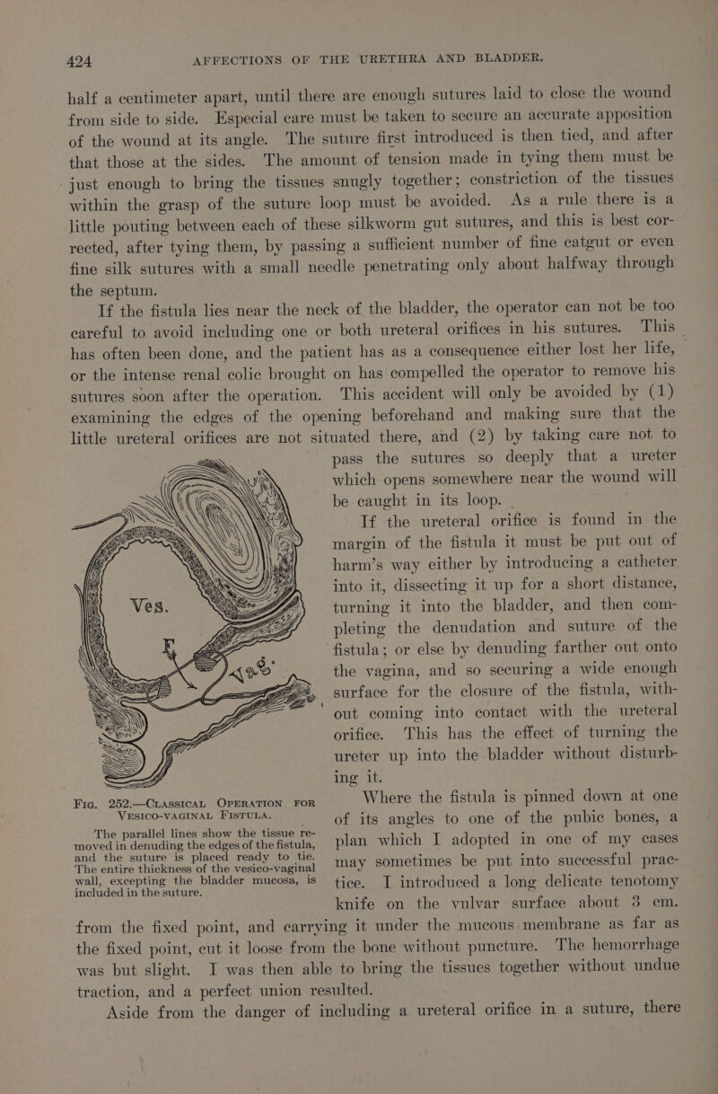 half a centimeter apart, until there are enough sutures laid to close the wound from side to side. Especial care must be taken to secure an accurate apposition of the wound at its angle. The suture first introduced is then tied, and after that those at the sides. The amount of tension made in tying them must be -just enough to bring the tissues snugly together; constriction of the tissues within the grasp of the suture loop must be avoided. As a rule there is a little pouting between each of these silkworm gut sutures, and this is best cor- rected, after tying them, by passing a sufficient number of fine catgut or even fine silk sutures with a small needle penetrating only about halfway through the septum. If the fistula lies near the neck of the bladder, the operator can not be too careful to avoid including one or both ureteral orifices in his sutures. This | has often been done, and the patient has as a consequence either lost her life, | or the intense renal colic brought on has compelled the operator to remove his sutures soon after the operation. This accident will only be avoided by (1) examining the edges of the opening beforehand and making sure that the little ureteral orifices are not situated there, and (2) by taking care not to pass the sutures so deeply that a ureter which opens somewhere near the wound will | be caught in its loop. | If the ureteral orifice is found in the margin of the fistula it must be put out of harm’s way either by introducing a catheter into it, dissecting it up for a short distance, turning it into the bladder, and then com- pleting the denudation and suture of the fistula; or else by denuding farther out onto the vagina, and so securing a wide enough surface for the closure of the fistula, with- out coming into contact with the ureteral orifice. This has the effect of turning the ureter up into the bladder without disturb- ing it. Fic. 252.—Cnasstcan OPERATION FOR Where the fistula is pinned down at one VESICO:YAGINAL, HISTUEAS. Sp otevits angles to one. of ythe, pubice DOlas ss The parallel lines show the tissue re- ; , moved in denuding the edges of the fistula, plan which I adopted in one of my cases and ‘the suture is placed ready to te” cay sometimes be put into successiulyprac: The entire thickness of the vesico-vaginal wall, excepting the bladder mucosa, is ; ; 7 a eae , tice. I introduced a long delicate tenotomy knife on the vulvar surface about 3 em. from the fixed point, and carrying it under the mucous membrane as far as the fixed point, cut it loose from the bone without puncture. The hemorrhage was but slight. I was then able to bring the tissues together without undue traction, and a perfect union resulted. Aside from the danger of including a ureteral orifice in a suture, there