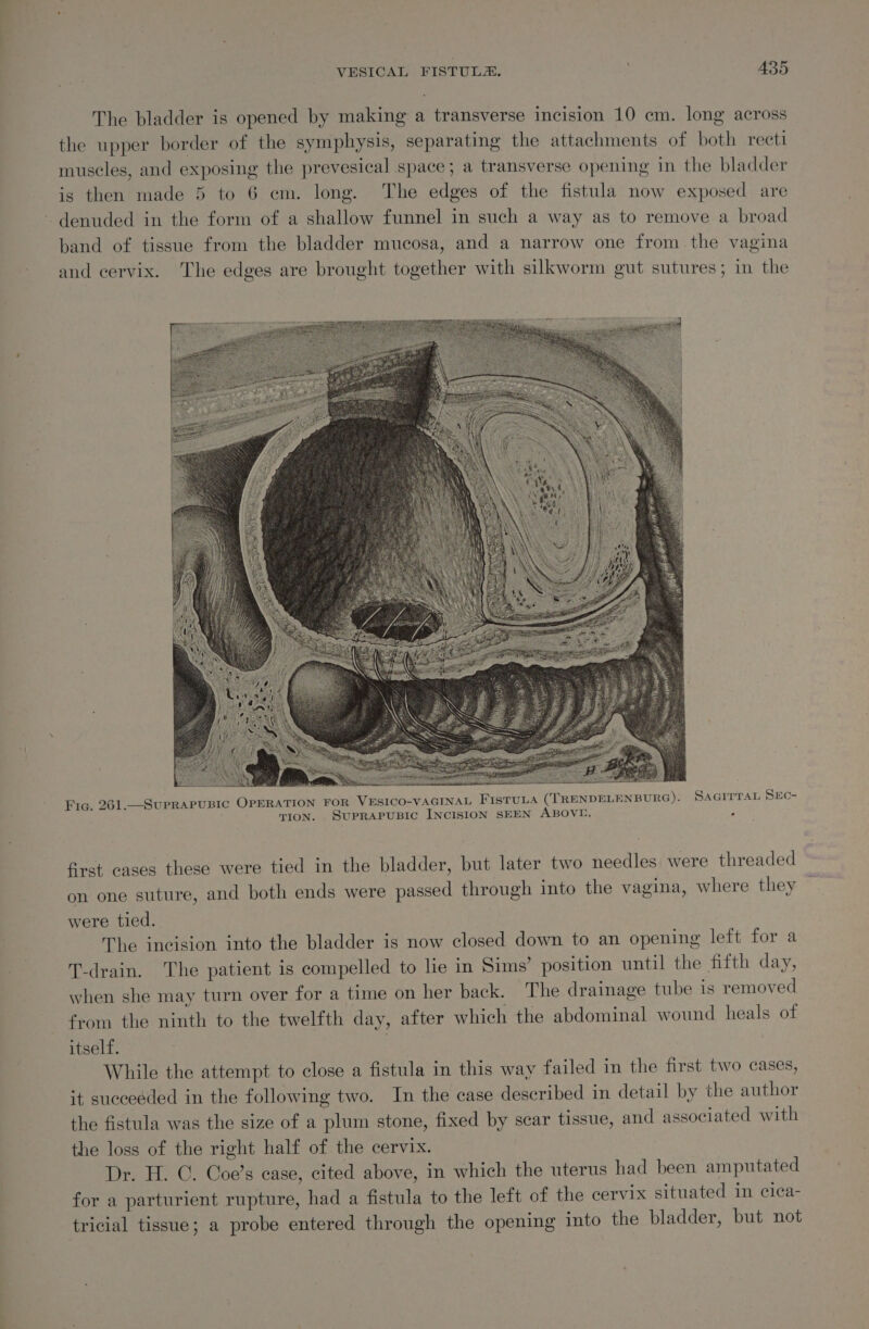 The bladder is opened by making a transverse incision 10 cm. long across the upper border of the symphysis, separating the attachments of both recti museles, and exposing the prevesical space; a transverse opening in the bladder is then made 5 to 6 em. long. The edges of the fistula now exposed are ~ denuded in the form of a shallow funnel in such a way as to remove a broad band of tissue from the bladder mucosa, and a narrow one from the vagina and cervix. The edges are brought together with silkworm gut sutures ; in the Fic. 261.—_SuPRAPUBIC OPERATION FOR VESICO-VAGINAL Fistuua (TRENDELENBURG). SAGITTAL SEc- . TION. SUPRAPUBIC INCISION SEEN ABOVE. first cases these were tied in the bladder, but later two needles were threaded on one suture, and both ends were passed through into the vagina, where they were tied. The incision into the bladder is now closed down to an opening left for a T-drain. The patient is compelled to lie in Sims’ position until the fifth day, when she may turn over for a time on her back. The drainage tube is removed from the ninth to the twelfth day, after which the abdominal wound heals of itself. | | While the attempt to close a fistula in this way failed in the first two cases, it succeeded in the following two. In the case described in detail by the author the fistula was the size of a plum stone, fixed by scar tissue, and associated with the loss of the right half of the cervix. Dr. H. GC. Coe’s ease, cited above, in which the uterus had been amputated for a parturient rupture, had a fistula to the left of the cervix situated in cica- tricial tissue; a probe entered through the opening into the bladder, but not