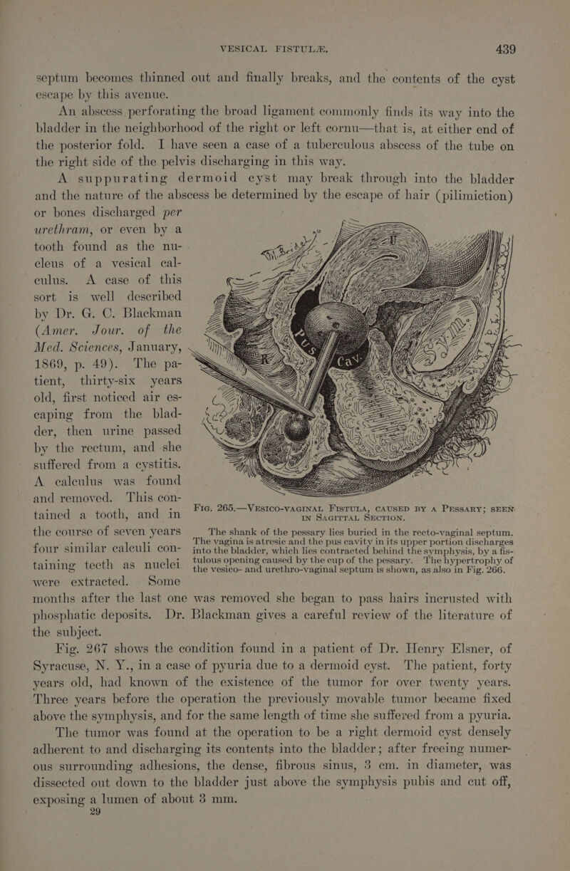 septum becomes thinned out and finally breaks, and the contents of the cyst escape by this avenue. An abscess perforating the broad ligament commonly finds its way into the bladder in the neighborhood of the right or left cornu—that is, at either end of the posterior fold. I have seen a case of a tuberculous abscess of the tube on the right side of the pelvis discharging in this way. A suppurating dermoid cyst may break through into the bladder and the nature of the abscess be determined by the escape of hair (pilimiction) or bones discharged per urethram, or even by a tooth found as the nu- cleus of a vesical cal- culus. &lt;A case of this sort is well described by Dr. G. C. Blackman (Amer. Jour. of the Med. Sciences, January, 1869, p. 49). The pa- tient, thirty-six years old, first noticed air es- caping from the blad- der, then urine passed by the rectum, and she suffered from a cystitis. A ealeulus was found and removed. This con- tulous opening caused by the cup of the pessary. - The hypertrophy of taining tecth as nuclei the vesico- and urethro-vaginal septum is shown, as also in Fig. 266. were extracted. Some &gt; months after the last one was removed she began to pass hairs incrusted with phosphatic deposits. Dr. Blackman gives a careful review of the literature of the subject. , Fig. 267 shows the condition found in a patient of Dr. Henry Elsner, of Syracuse, N. Y., in a case of pyuria due to a dermoid cyst. The patient, forty years old, had known of the existence of the tumor for over. twenty years. Three years before the operation the previously movable tumor became fixed above the symphysis, and for the same length of time she suffered from a pyuria. The tumor was found at the operation to be a right dermoid cyst densely adherent to and discharging its contents into the bladder; after freeing numer: ous surrounding adhesions, the dense, fibrous sinus, 3 cm. in diameter, was dissected out down to the bladder just above the symphysis pubis and cut off, exposing apne of about 3 mm.