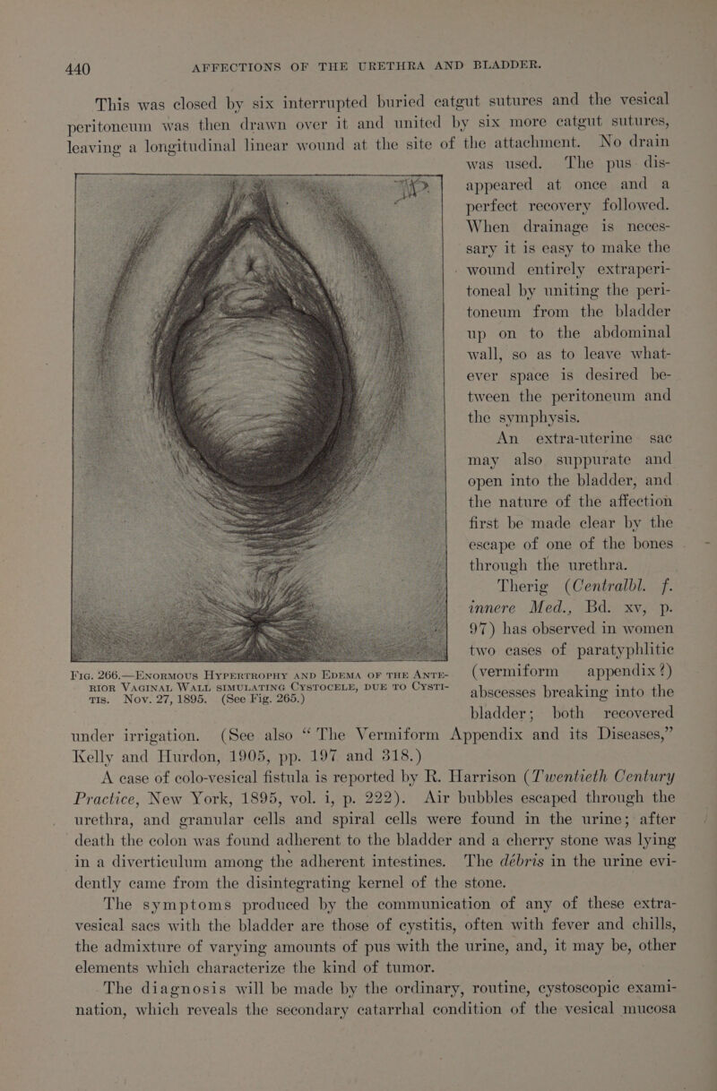 This was closed by six interrupted buried catgut sutures and the vesical peritoneum was then drawn over it and united by six more catgut sutures, leaving a longitudinal linear wound at the site of the attachment. No drain was used. The pus. dis- appeared at once and a perfect recovery followed. When drainage is neces- sary it is easy to make the - wound entirely extraperi- toneal by uniting the peri- toneum from the bladder up on to the abdominal wall, so as to leave what- ever space is desired be- tween the peritoneum and the symphysis. An extra-uterine sac may also suppurate and open into the bladder, and the nature of the affection first be made clear by the escape of one of the bones through the urethra. Therig (Centralbl. f. innere Med., Bd. xv, p. 97) has observed in women | two cases of paratyphlitie Fic. 266.—ENormMovus HyperRTROPHY AND EDEMA OF THE ANTE- (vermiform appendix 2) Sige Nower. feaen PORE PEE een DUE T0 CYsTI- abscesses breaking into the bladder; both recovered under irrigation. (See also “ The Vermiform Appendix and its Diseases,” Kelly and Hurdon, 1905, pp. 197 and 318.) A ease of colo-vesical fistula is reported by R. Harrison (Twentieth Century Practice, New York, 1895, vol. i, p. 222). Air bubbles escaped through the urethra, and granular cells and spiral cells were found in the urine; after death the colon was found adherent to the bladder and a cherry stone was lying in a diverticulum among the adherent intestines. The débris in the urine evi- dently came from the disintegrating kernel of the stone. | The symptoms produced by the communication of any of these extra- vesical sacs with the bladder are those of cystitis, often with fever and chills, the admixture of varying amounts of pus with the urine, and, it may be, other elements which characterize the kind of tumor. — . The diagnosis will be made by the ordinary, routine, cystoscopic exami- nation, which reveals the secondary catarrhal condition of the vesical mucosa