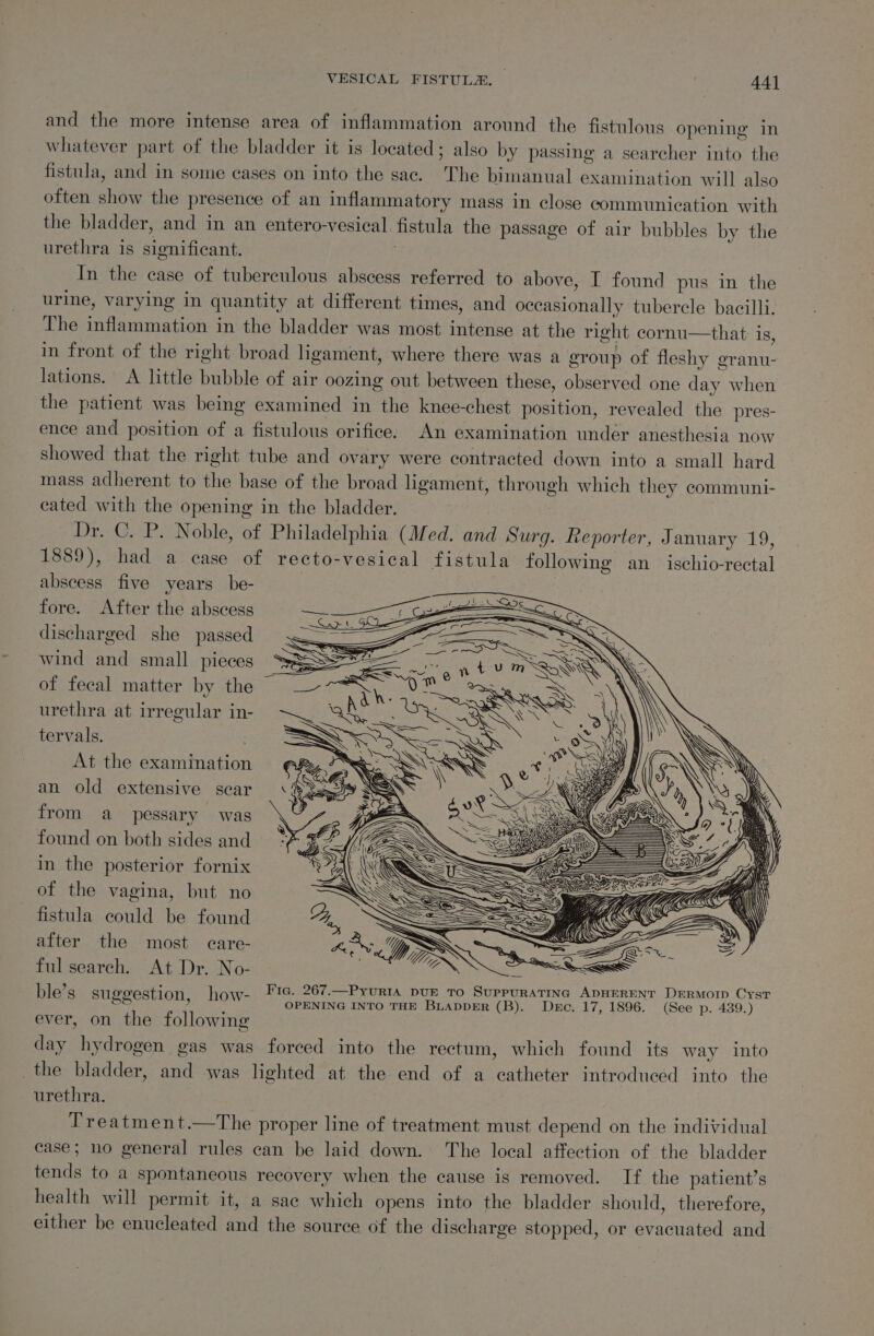 and the more intense area of inflammation around the fistulous opening in whatever part of the bladder it is located; also by passing a searcher into the fistula, and in some cases on into the sac. The bimanual examination will also often show the presence of an inflammatory mass in close communication with the bladder, and in an entero-vesical. fistula the passage of air bubbles by the urethra is significant. In the case of tuberculous abscess referred to above, I found pus in the urine, varying in quantity at different times, and occasionally tubercle bacilli. The inflammation in the bladder was most intense at the right cornu—that: is, in front of the right broad ligament, where there was a group of fleshy granu- lations. A little bubble of air oozing out between these, observed one day when the patient was being examined in the knee-chest position, revealed the pres- ence and position of a fistulous orifice. An examination under anesthesia now showed that the right tube and ovary were contracted down into a small hard mass adherent to the base of the broad ligament, through which they communi- eated with the opening in the bladder. Dr. C. P. Noble, of Philadelphia (Med. and Surg. Reporter, January 19, 1889), had a case of recto-vesical fistula following an_ ischio-rectal abscess five years be- | fore. After the abscess discharged she passed wind and small pieces of fecal matter by the urethra at irregular in- tervals. ; At the examination an old extensive scar from a pessary was found on both sides and in the posterior fornix of the vagina, but no fistula could be found after the most care- ful search. At Dr. No- ? ; _ Fic. 267.—Pyurta DUE TO SuPpPuRATING ADHERENT DERMOID CysT ble’s suggestion, how OPENING INTO THE BLADDER (B). Dec. 17, 1896. (See p. 439.) ever, on the following day hydrogen gas was forced into the rectum, which found its way into the bladder, and was lighted at the end of a catheter introduced into the urethra. Treatment.—The proper line of treatment must depend on the individual case; no general rules can be laid down. The local affection of the bladder tends to a spontaneous recovery when the cause is removed. If the patient’s health will permit it, a sae which opens into the bladder should, therefore, either be enucleated and the source of the discharge stopped, or evacuated and