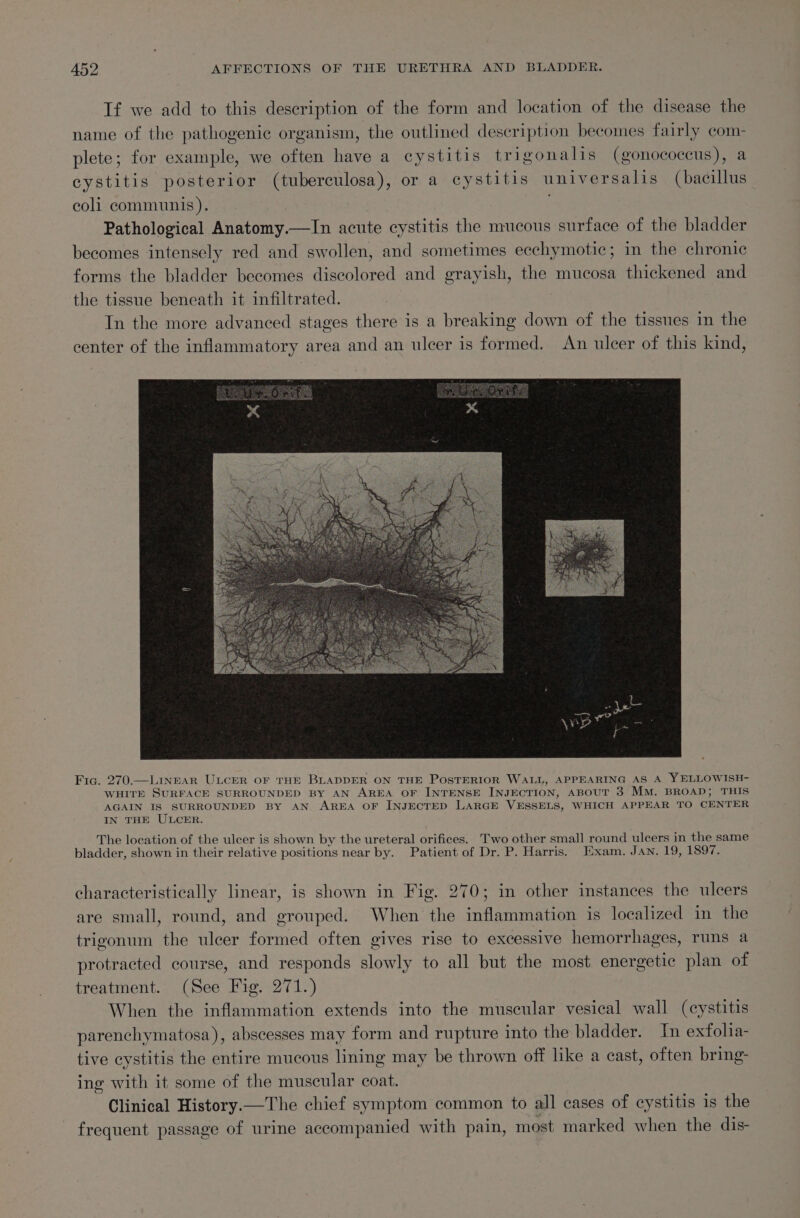 Tf we add to this description of the form and location of the disease the name of the pathogenic organism, the outlined description becomes fairly com- plete; for example, we often have a cystitis trigonalis (gonococcus), a cystitis posterior (tuberculosa), or a cystitis universalis (bacillus coli communis). Pathological Anatomy.—In acute cystitis the mucous surface of the bladder becomes intensely red and swollen, and sometimes ecchymotic; in the chronic forms the bladder becomes discolored and grayish, the mucosa thickened and the tissue beneath it infiltrated. In the more advanced stages there is a breaking down of the tissues in the center of the inflammatory area and an ulcer is formed. An ulcer of this kind, Fic. 270.—LingeEAR ULCER OF THE BLADDER ON THE PosTERIOR WALL, APPEARING AS A YELLOWISH- WHITE SURFACE SURROUNDED BY AN AREA OF INTENSE INJECTION, ABOUT 3 MM. BROAD; THIS AGAIN IS SURROUNDED BY AN. AREA OF INJECTED LARGE VESSELS, WHICH APPEAR TO CENTER IN THE ULCER. The location of the ulcer is shown by the ureteral orifices. Two other small round ulcers in the same bladder, shown in their relative positions near by. Patient of Dr. P. Harris. Exam. Jan. 19, 1897. characteristically linear, is shown in Fig. 270; in other instances the ulcers are small, round, and grouped. When the inflammation is localized in the trigonum the ulcer formed often gives rise to excessive hemorrhages, runs a protracted course, and responds slowly to all but the most energetic plan of treatment. (See Fig. 271.) When the inflammation extends into the muscular vesical wall (cystitis parenchymatosa), abscesses may form and rupture into the bladder. In exfolia- tive cystitis the entire mucous lining may be thrown off like a cast, often bring- ing with it some of the muscular coat. Clinical History.—The chief symptom common to all cases of cystitis is the frequent passage of urine accompanied with pain, most marked when the dis-