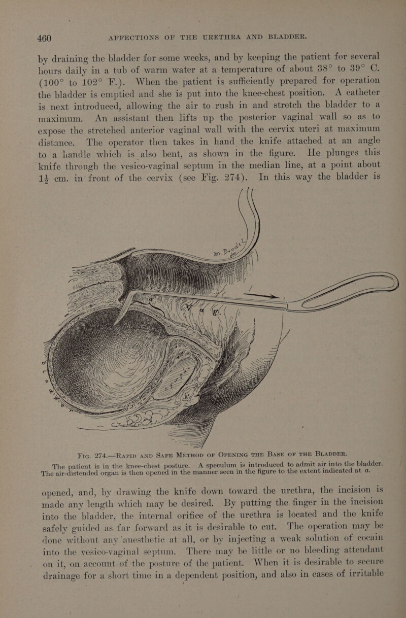 by draining the bladder for some weeks, and by keeping the patient for several hours daily in a tub of warm water at a temperature of about 38° to 39° C. (100° to 102° F.). When the patient is sufficiently prepared for operation the bladder is emptied and she is put into the knee-chest position. A catheter is next introduced, allowing the air to rush in and stretch the bladder to a maximum. An assistant then lifts up the posterior vaginal wall so as to expose the stretched anterior vaginal wall with the cervix uteri at maximum distance. The operator then takes in hand the knife attached at an angle to a handle which is also bent, as shown in the figure. He plunges this ‘knife through the vesico-vaginal septum in the median line, at a point about 14 cm. in front of the cervix (see Fig. 274). In this way the bladder 1s Fic. 274.—Rapip AND SAFE METHOD OF OPENING THE BASE OF THE BLADDER. The patient is in the knee-chest posture. A speculum is introduced to admit air into the bladder. . - The air-distended organ is then opened in the manner seen in the figure to the extent indicated at a. opened, and, by drawing the knife down toward the urethra, the incision is made any length which may be desired. By putting the finger in the incision into the bladder, the internal orifice of the urethra is located and the knife safely guided as far forward as it is desirable to cut. The operation may be done without any ‘anesthetie at all, or by injecting a weak solution of eocain into the vesico-vaginal septum. There may be little or no bleeding attendant on it, on account of the posture of the patient. When it is desirable to secure drainage for a short time in a dependent position, and also in cases of irritable