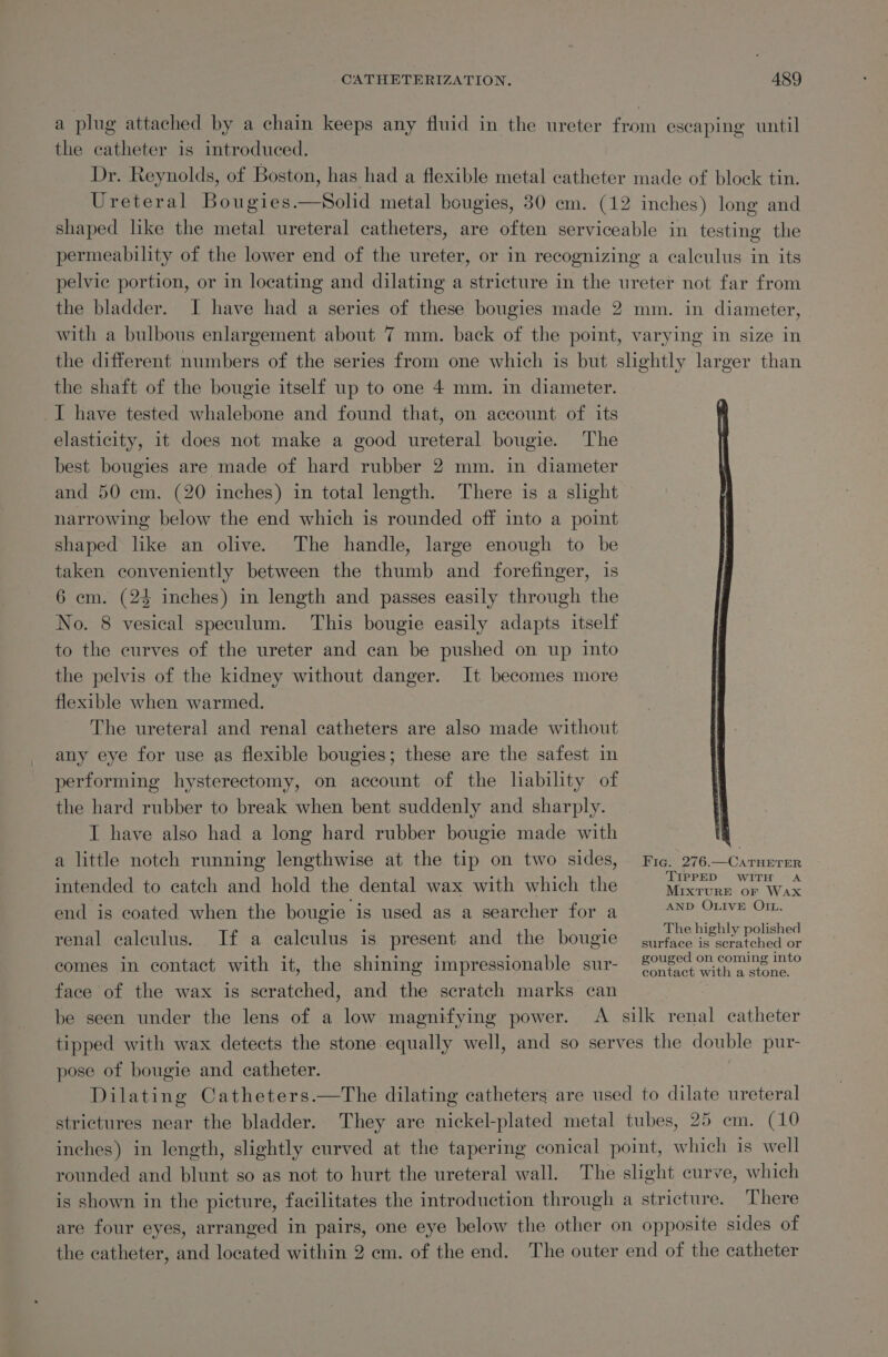 a plug attached by a chain keeps any fluid in the ureter from escaping until the catheter is introduced. Dr. Reynolds, of Boston, has had a flexible metal catheter made of block tin. Ureteral Bougies.—Solid metal bougies, 30 em. (12 inches) long and shaped lke the metal ureteral catheters, are often serviceable in testing the permeability of the lower end of the ureter, or in recognizing a calculus in its pelvic portion, or in locating and dilating a stricture in the ureter not far from the bladder. I have had a series of these bougies made 2 mm. in diameter, with a bulbous enlargement about 7 mm. back of the point, varying in size in the different numbers of the series from one which is but slightly larger than the shaft of the bougie itself up to one 4 mm. in diameter. I have tested whalebone and found that, on account of its elasticity, it does not make a good ureteral bougie. The best bougies are made of hard rubber 2 mm. in diameter and 50 em. (20 inches) in total length. There is a slight narrowing below the end which is rounded off into a point shaped like an olive. The handle, large enough to be taken conveniently between the thumb and forefinger, is 6 cm. (24 inches) in length and passes easily through the No. 8 vesical speculum. This bougie easily adapts itself to the curves of the ureter and can be pushed on up into the pelvis of the kidney without danger. It becomes more flexible when warmed. The ureteral and renal catheters are also made without any eye for use as flexible bougies; these are the safest in performing hysterectomy, on account of the liability of the hard rubber to break when bent suddenly and sharply. I have also had a long hard rubber bougie made with 4 a little notch running lengthwise at the tip on two sides, Fic. 276—Carnerer intended to catch and hold the dental wax with which the 1 aa ea end is coated when the bougie is used as a searcher for a Apa emoal renal calculus. If a calculus is present and the bougie ses ah ache Sa Seca comes in contact with it, the shining impressionable sur- £0uged on coming into face of the wax is scratched, and the scratch marks can be seen under the lens of a low magnifying power. A silk renal catheter tipped with wax detects the stone equally well, and so serves the double pur- pose of bougie and catheter. Dilating Catheters.—The dilating catheters are used to dilate ureteral strictures near the bladder. They are nickel-plated metal tubes, 25 em. (10 inches) in length, slightly curved at the tapering conical point, which is well rounded and blunt so as not to hurt the ureteral wall. The slight curve, which is shown in the picture, facilitates the introduction through a stricture. There are four eyes, arranged in pairs, one eye below the other on opposite sides of the catheter, and located within 2 cm. of the end. The outer end of the catheter