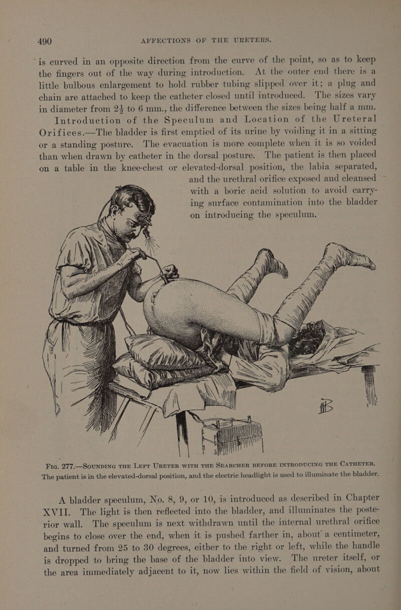 is curved in an opposite direction from the curve of the point, so as to keep the fingers out of the way during introduction. At the outer end there is a little bulbous enlargement to hold rubber tubing slipped over it; a plug and chain are attached to keep the catheter closed until introduced. The sizes vary in diameter from 24 to 6 mm., the difference between the sizes being half a mm. Introduction of the Speculum and Location of the Ureteral Orifices.—The bladder is first emptied of its urine by voiding it in a sitting or a standing posture. The evacuation is more complete when it is so voided than when drawn by catheter in the dorsal posture. The patient is then placed on a table in the knee-chest or elevated-dorsal position, the labia separated, and the urethral orifice exposed and cleansed with a boric acid solution to avoid carry- ing surface contamination into the bladder on introducing the speculum. = —S—&gt; SSS We memes The patient is in the elevated-dorsal position, and the electric headlight is used to illuminate the bladder. A bladder speculum, No. 8, 9, or 10, is introduced as described in Chapter XVII. The light is then reflected into the bladder, and illuminates the poste- rior wall. The speculum is next withdrawn until the internal urethral orifice begins to close over the end, when it is pushed farther in, about a centimeter, and turned from 25 to 30 degrees, either to the right or left, while the handle is dropped to bring the base of the bladder into view. The ureter itself, or the area immediately adjacent to it, now lies within the field of vision, about