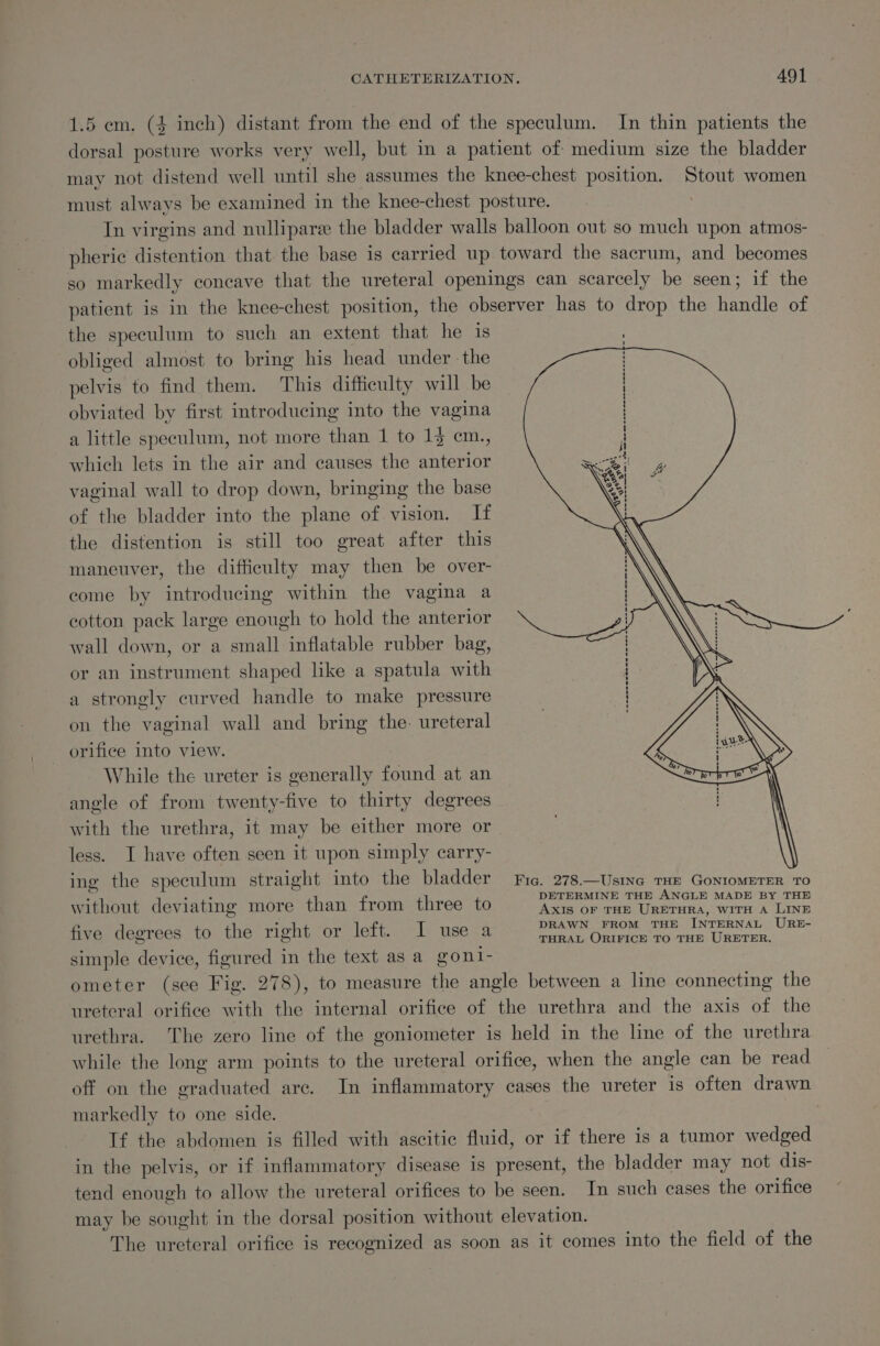 1.5 em. (4 inch) distant from the end of the speculum. In thin patients the dorsal posture works very well, but in a patient of medium size the bladder may not distend well until she assumes the knee-chest position. Stout women must always be examined in the knee-chest posture. : In virgins and nullipare the bladder walls balloon out so much upon atmos- pheri¢ distention that. the base is carried up toward the sacrum, and becomes so markedly concave that the ureteral openings can scarcely be seen; if the patient is in the knee-chest position, the observer has to drop the handle of the speculum to such an extent that he 1s obliged almost to bring his head under the pelvis to find them. This difficulty will be obviated by first introducing into the vagina a little speculum, not more than 1 to 13 cm., which lets in the air and causes the anterior vaginal wall to drop down, bringing the base of the bladder into the plane of vision. If the distention is still too great after this maneuver, the difficulty may then be over- come by introducing within the vagina a cotton pack large enough to hold the anterior wall down, or a small inflatable rubber bag, or an instrument shaped like a spatula with a strongly curved handle to make pressure on the vaginal wall and bring the. ureteral - orifice into view. While the ureter is generally found at an angle of from twenty-five to thirty degrees with the urethra, it may be either more or less. I have often seen it upon simply carry- ing the speculum straight into the iodine ra eeTs Uae in GonioMeEroR iro without deviating more than from three to Ce ey ee ae five degrees to the right or left. I use a she toe, eae THE INTERNAL be se simple device, figured in the text as a gont- ometer (see Fig. 278), to measure the angle between a line connecting the ureteral orifice with the internal orifice of the urethra and the axis of the urethra. The zero line of the goniometer is held in the line of the urethra while the long arm points to the ureteral orifice, when the angle can be read off on the graduated are. In inflammatory cases the ureter is often drawn markedly to one side. : If the abdomen is filled with ascitic fluid, or if there is a tumor wedged in the pelvis, or if inflammatory disease is present, the bladder may not dis- tend enough to allow the ureteral orifices to be seen. In such cases the orifice may be sought in the dorsal position without elevation. The ureteral orifice is recognized as soon as it comes into the field of the