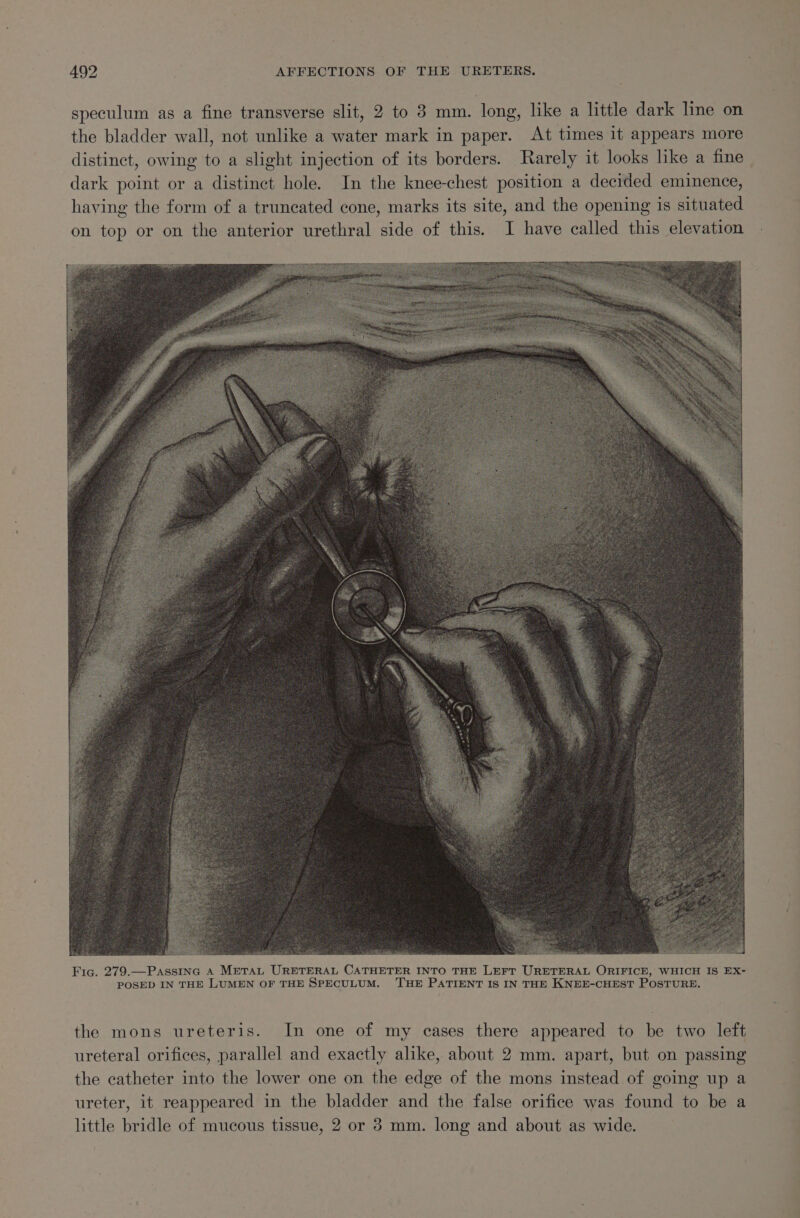 speculum as a fine transverse slit, 2 to 3 mm. long, like a little dark line on the bladder wall, not unlike a water mark in paper. At times it appears more distinct, owing to a slight injection of its borders. Rarely it looks like a fine dark point or a distinct hole. In the knee-chest position a decided eminence, having the form of a truncated cone, marks its site, and the opening is situated on top or on the anterior urethral side of this. I have called this elevation the mons ureteris. In one of my cases there appeared to be two left ureteral orifices, parallel and exactly alike, about 2 mm. apart, but on passing the catheter into the lower one on the edge of the mons instead of going up a ureter, it reappeared in the bladder and the false orifice was found to be a little bridle of mucous tissue, 2 or 3 mm. long and about as wide.