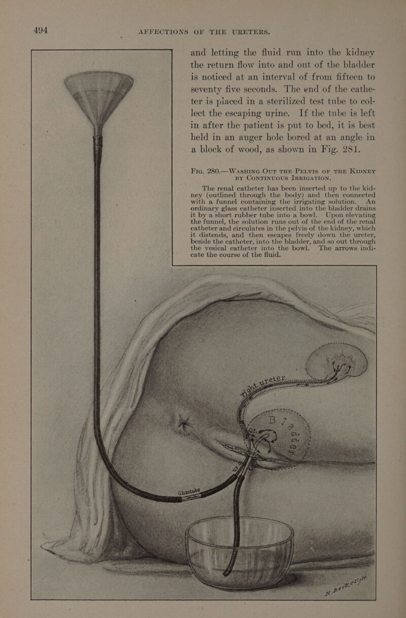 and letting the fluid run into the kidney the return flow into and out of the bladder is noticed at an interval of from fifteen to seventy five seconds. The end of the cathe- ter is placed in a sterilized test tube to col- lect the escaping urine. If the tube is left in after the patient is put to bed, it is best held in an auger hole bored at an angle in a block of wood, as shown in Fig. 281. Fig. 280.—WaASHING OuT THE PELVIS OF THE KIDNEY By CONTINUOUS IRRIGATION. The renal catheter has been inserted up to the kid- ney (outlined through the body) and then connected with a funnel containing the irrigating solution. An ordinary glass catheter inserted into the bladder drains it by a short rubber tube into a bowl. Upon elevating the funnel, the solution runs out of the end of the renal catheter and circulates in the pelvis of the kidney, which it distends, and then escapes freely down the ureter, beside the catheter, into the bladder, and so out through the vesical catheter into the bowl. The arrows indi- cate the course of the fluid.