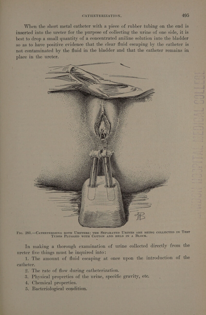 When the short metal catheter with a piece of rubber tubing on the end is inserted into the ureter for the purpose of collecting the urine of one side, it is best to drop a small quantity of a concentrated aniline solution into the bladder so as to have positive evidence that the clear fluid escaping by the catheter is not contaminated by the fluid in the bladder and that the catheter remains in place in the ureter. , Fic. 281.—CATHETERIZING BOTH URETERS; THE SEPARATED URINES ARE BEING COLLECTED IN TEST TunEes PLUGGED wiTtH CoTTON AND HELD IN A BLOCK. In making a thorough examination of urine collected directly from the ureter five things must be inquired into: 1. The amount of fluid escaping at once upon the introduction of the catheter. | | 2. The rate of flow during catheterization. 3. Physical properties of the urine, specific gravity, ete. 4, Chemical properties. 5. Bacteriological condition.