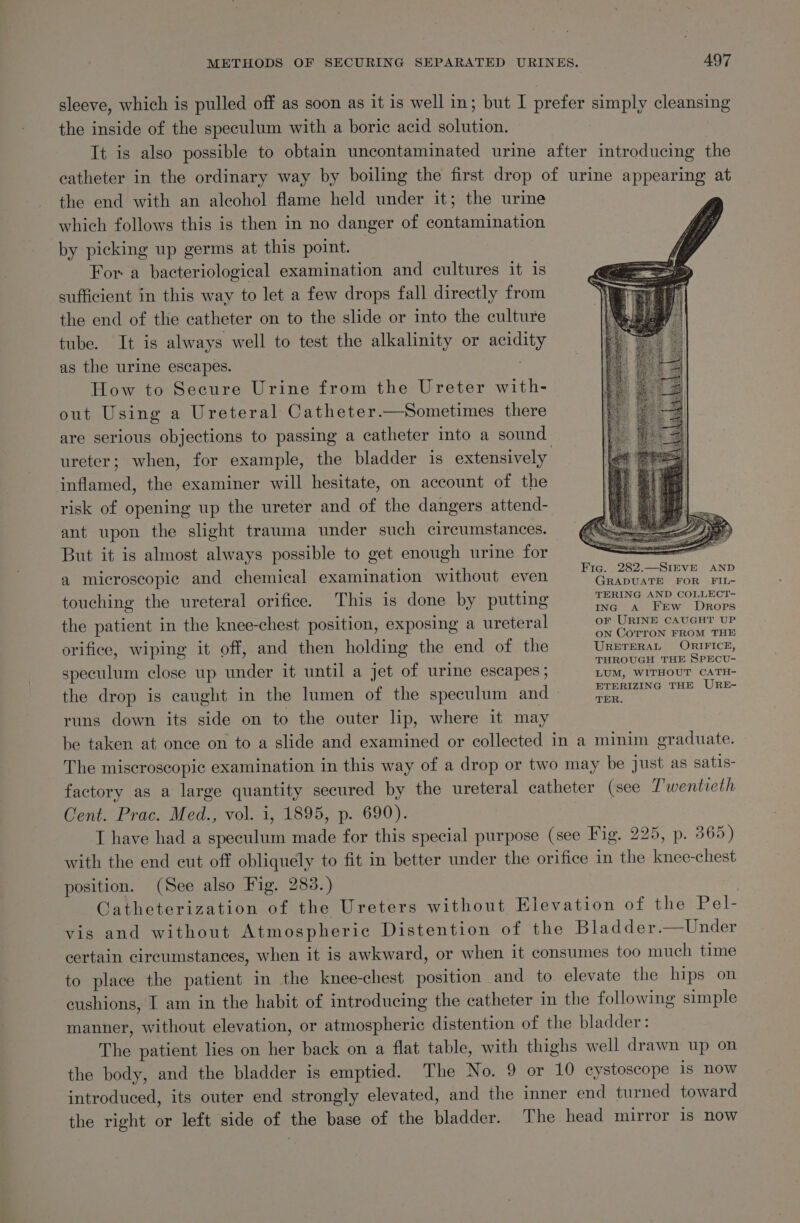 sleeve, which is pulled off as soon as it is well in; but I prefer simply cleansing the inside of the speculum with a boric acid solution. It is also possible to obtain uncontaminated urine after introducing the catheter in the ordinary way by boiling the first drop of urine appearing at the end with an alcohol flame held under it; the urine which follows this is then in no danger of contamination by picking up germs at this point. : For a bacteriological examination and cultures it 1s sufficient in this way to let a few drops fall directly from the end of the catheter on to the slide or into the culture tube. It is always well to test the alkalinity or acidity as the urine escapes. : How to Secure Urine from the Ureter with- out Using a Ureteral Catheter.—Sometimes there are serious objections to passing a catheter into a sound ureter; when, for example, the bladder 1s extensively inflamed, the examiner will hesitate, on account of the risk of opening up the ureter and of the dangers attend- ant upon the slight trauma under such circumstances. But it is almost always possible to get enough urine for Fig. 282.—SIEVE AND a microscopic and chemical examination without even Fate ger eae | aict5: ino 1 7 1 Ino TERING AND COLLECT- touching the ureteral orifice. This 1s done by putting Pte MERE Se ikon the patient in the knee-chest position, exposing a ureteral OF URINE CAUGHT UP . Sete ; is 2 ON COTTON FROM THE orifice, wiping it off, and then holding the end of the URETERAL ORIFICE, q ; : : THROUGH THE SPECU- speculum close up under it until a jet of urine escapes ; LUM, WITHOUT CATH- ETERIZING THE URE- the drop is caught in the lumen of the speculum and ger, runs down its side on to the outer lip, where it may be taken at once on to a slide and examined or collected in a minim graduate. The miscroscopic examination in this way of a drop or two may be Just as satis- factory as a large quantity secured by the ureteral catheter (see Twentieth Cent. Prac. Med., vol. i, 1895, p. 690). IT have had a speculum made for this special purpose (see Fig. 225, p. 365) with the end cut off obliquely to fit in better under the orifice in the knee-chest position. (See also Fig. 283.) | Gatheterization of the Ureters without Elevation of the Pel- vis and without Atmospheric Distention of the Bladder.—Under certain circumstances, when it is awkward, or when it consumes too much time to place the patient in the knee-chest position and to elevate the hips on cushions, I am in the habit of introducing the catheter in the following simple manner, without elevation, or atmospheric distention of the bladder: The patient lies on her back on a flat table, with thighs well drawn up on the body, and the bladder is emptied. The No. 9 or 10 cystoscope is Now introduced, its outer end strongly elevated, and the inner end turned toward the right or left side of the base of the bladder. The head mirror is now