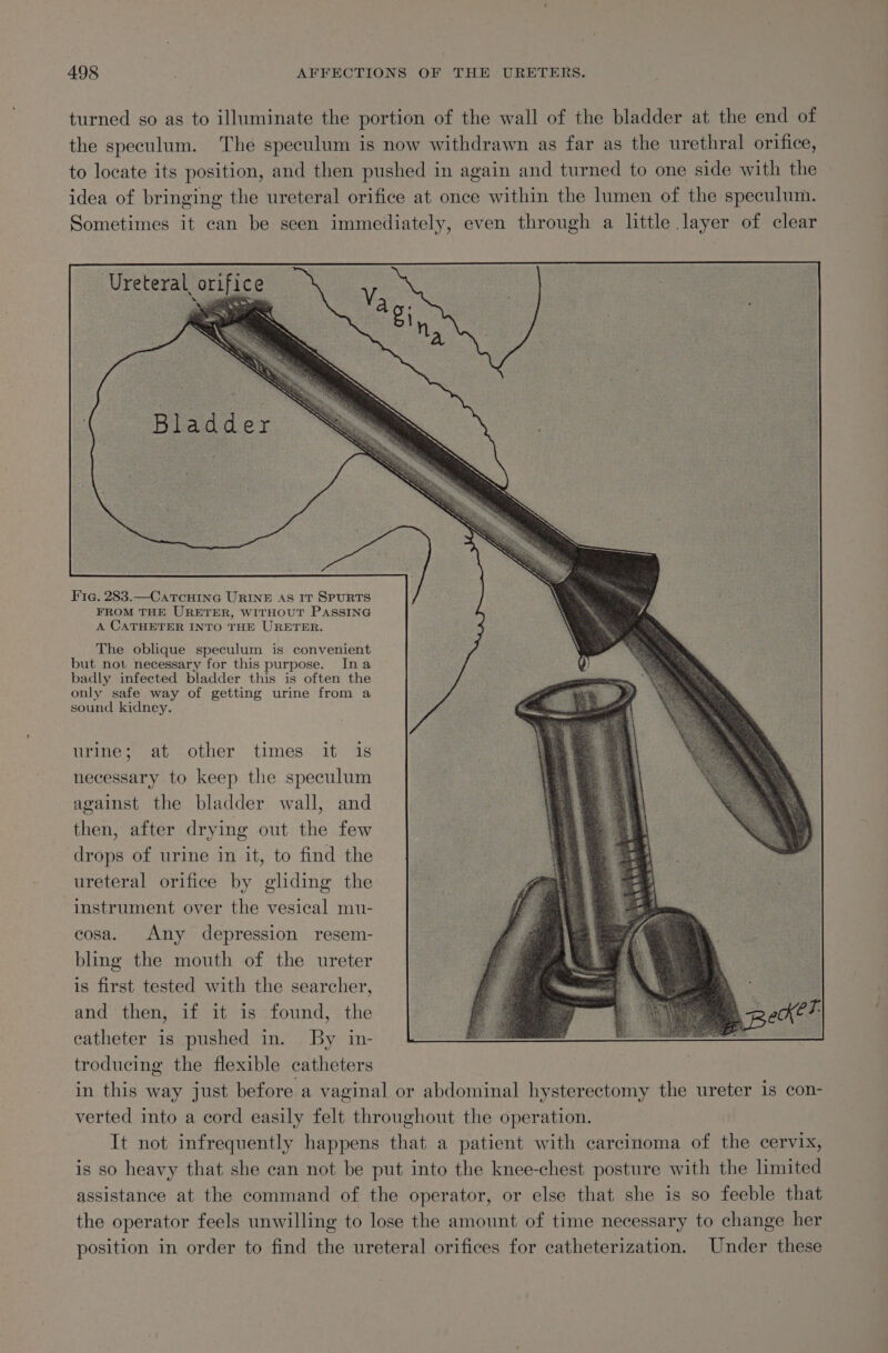 turned so as to illuminate the portion of the wall of the bladder at the end of the speculum. The speculum is now withdrawn as far as the urethral orifice, to locate its position, and then pushed in again and turned to one side with the idea of bringing the ureteral orifice at once within the lumen of the speculum. Sometimes it can be seen immediately, even through a little layer of clear -Ureteral orifice eet Fig. 283.—CatcHiInG URINE As IT SPURTS FROM THE URETER, WITHOUT PASSING A CATHETER INTO THE URETER. The oblique speculum is convenient but not necessary for this purpose. Ina badly infected bladder this is often the only safe way of getting urine from a sound kidney. urine; at other times it is necessary to keep the speculum against the bladder wall, and then, after drying out the few drops of urine in it, to find the ureteral orifice by glding the instrument over the vesical mu- cosa. Any depression resem- bling the mouth of the ureter is first tested with the searcher, and then, if it is found, the catheter is pushed in. By in- troducing the flexible catheters in this way just before a vaginal or abdominal hysterectomy the ureter is con- verted into a cord easily felt throughout the operation. It not infrequently happens that a patient with carcinoma of the cervix, is so heavy that she can not be put into the knee-chest posture with the limited assistance at the command of the operator, or else that she is so feeble that the operator feels unwilling to lose the amount of time necessary to change her position in order to find the ureteral orifices for catheterization. Under these